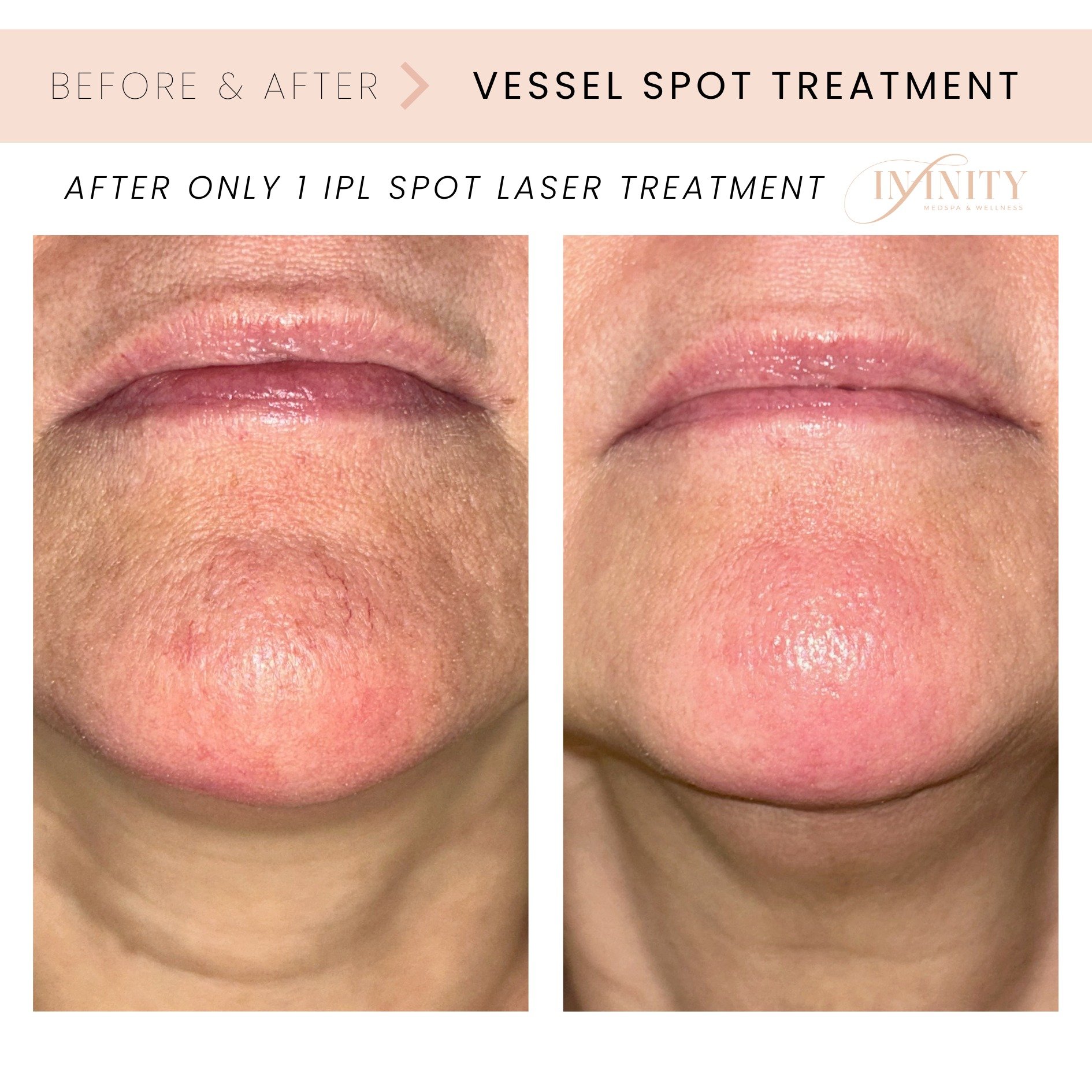 Amazing result after 1 IPL spot treatment with @theskinvixen!😍

Katie treated this patients vessel on her chin with the IPL laser!

IPL Laser is treats a variety of skin concerns including:
⭐ Skin pigmentation - sun damage, age spots, freckles, hype