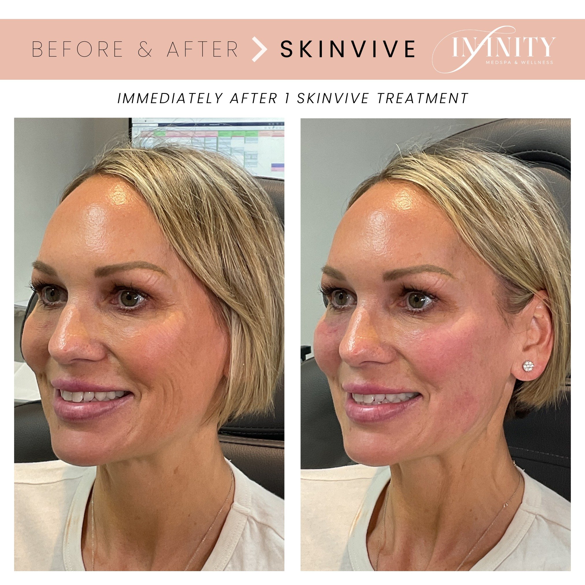 Immediately after SKINVIVE by JUV&Eacute;DERM&reg; with @brooks.np! 😍

SKINVIVE is the first &amp; only hyaluronic acid microdroplet injectable that helps the skin retain its natural moisture and softness and improves smoothness of the cheeks!

The 