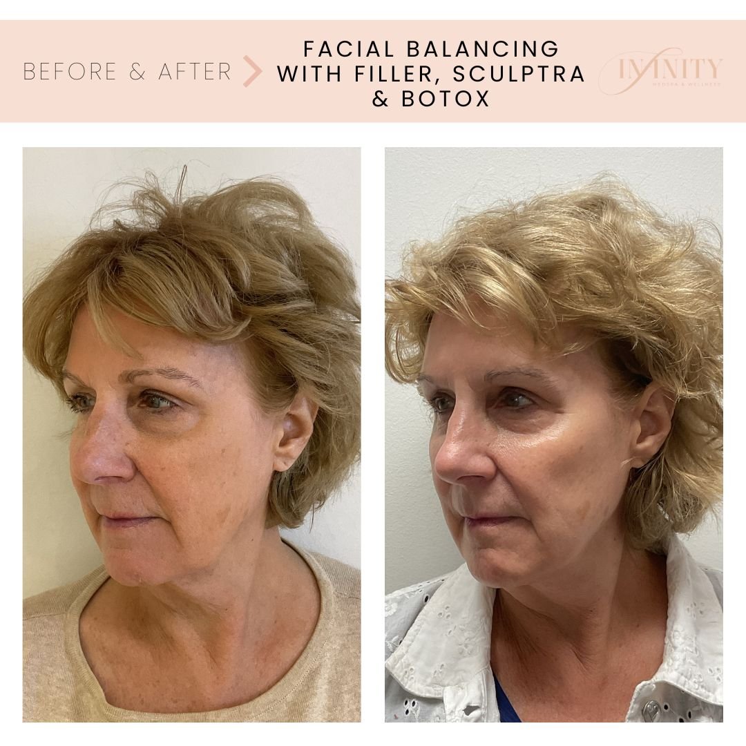@injector.rachelwhite has worked with this beautiful patient since June 2023!

Rachel used the following to help improve facial balancing while creating a youthful, lifted appearance and defining her cheeks and jawline!
⭐ Filler for cheeks &amp; jawl