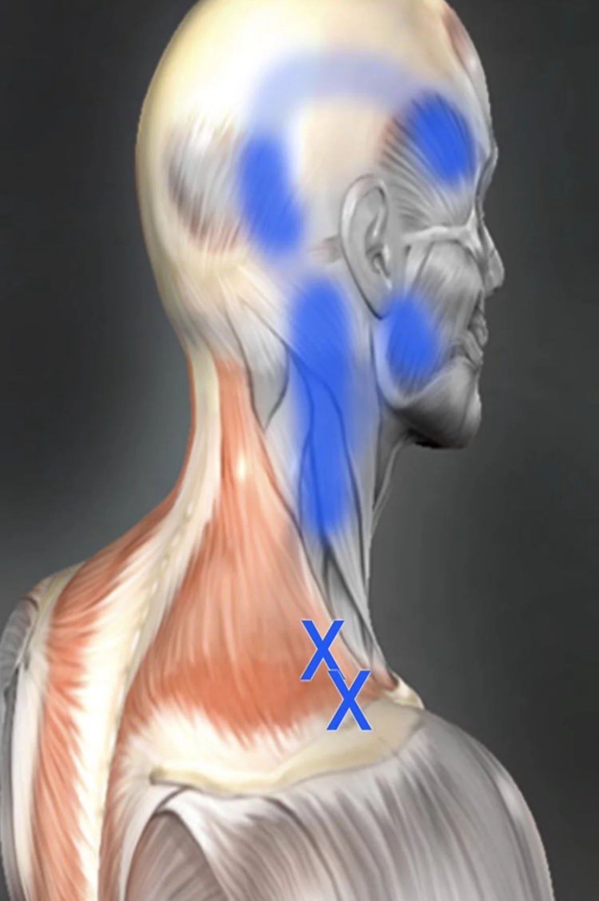 Upper Trapizeus Trigger  points
