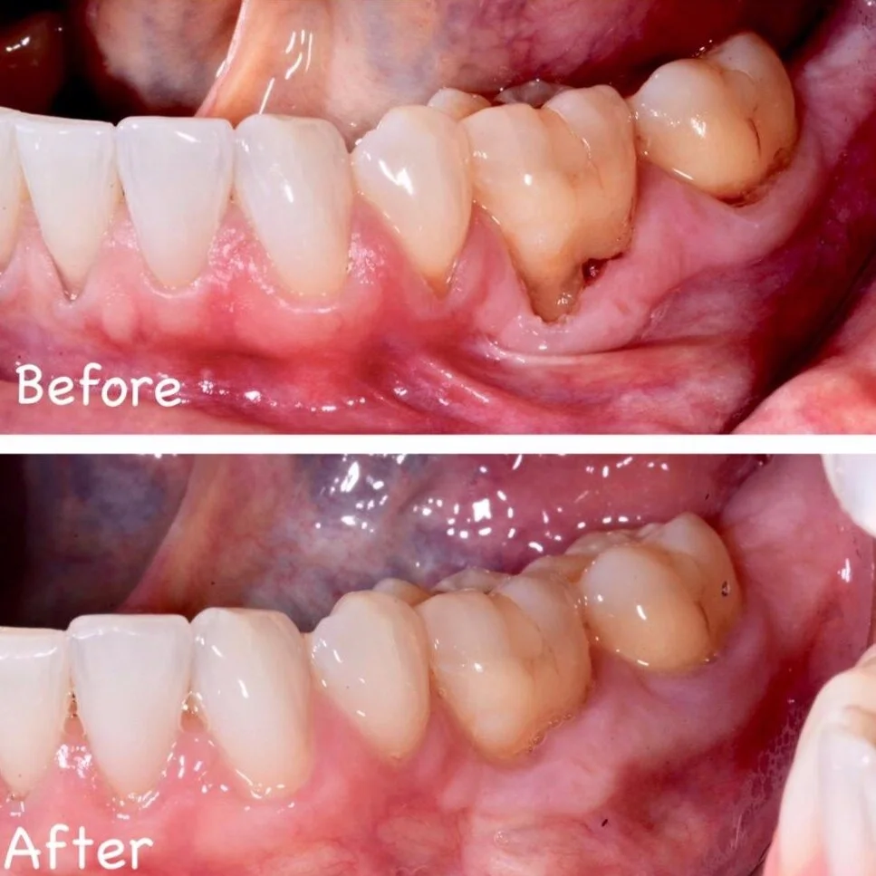 Pinhole Surgical Technique — Wenatchee Dental