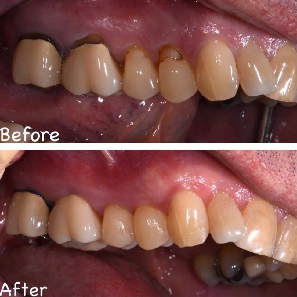 Pinhole Surgical Technique — Wenatchee Dental