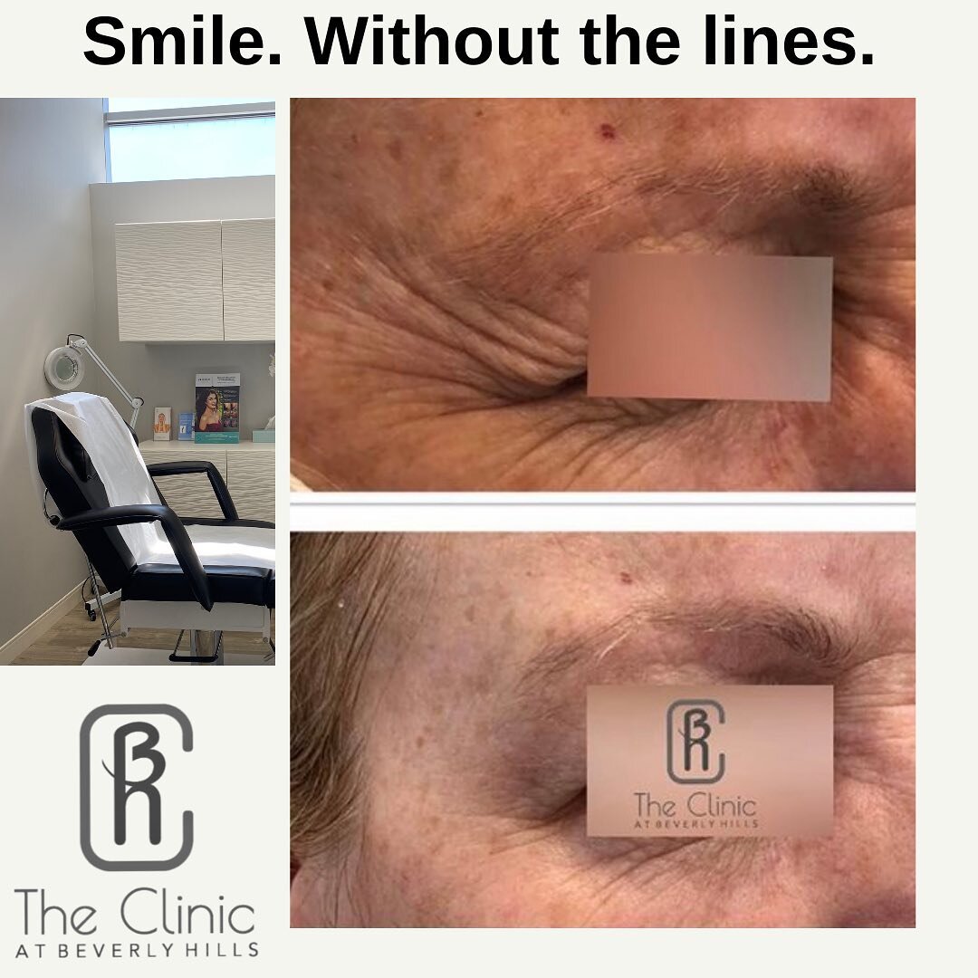 🏆Goal: Get Rid of lines and smooth out the crows feet
 💉 Treatment: Botulinum toxin (Nuceiva)
📝 How Many Units used: 24 Units 
💰 Approximate Cost:$175-$275
🤔How Long will it last: Typically results lasts for 3 months but can last longer. 
😩Pain