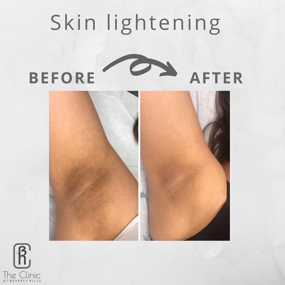 The skin lightening system is all natural. NO BLEACH. To help lighten our intimate areas.

⚠️cost starts at $200

Call for a consult today with one of our medical consultants.

The Clinic at Beverly Hills
647. 967. 3233

#skinlightening #lightening #
