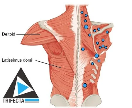 “Knots” and “Trigger Points”: How to Untie the Knot and Be Active in ...