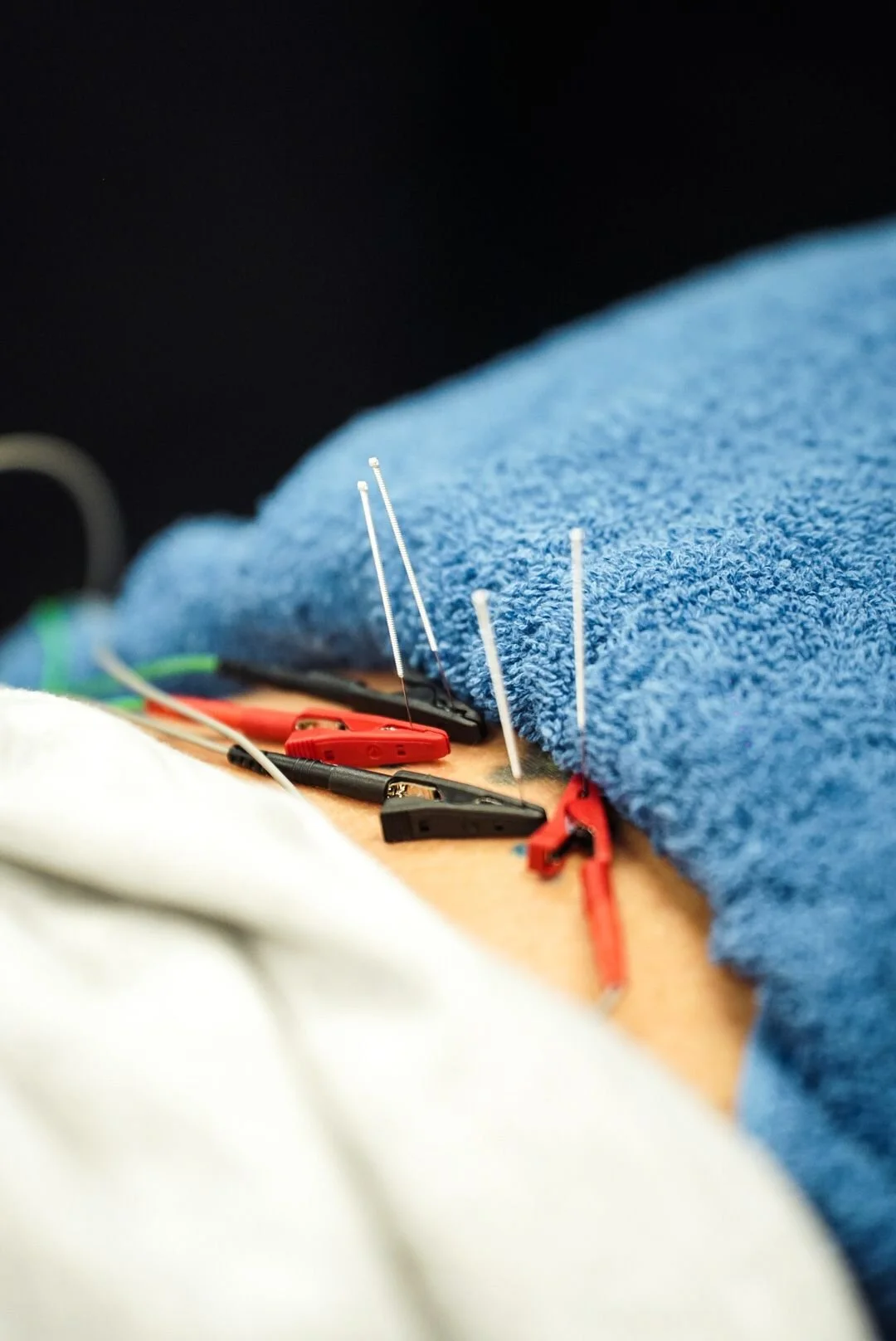 Dry Needling Therapy For Pain Sports Physical Therapy & Orthopedic