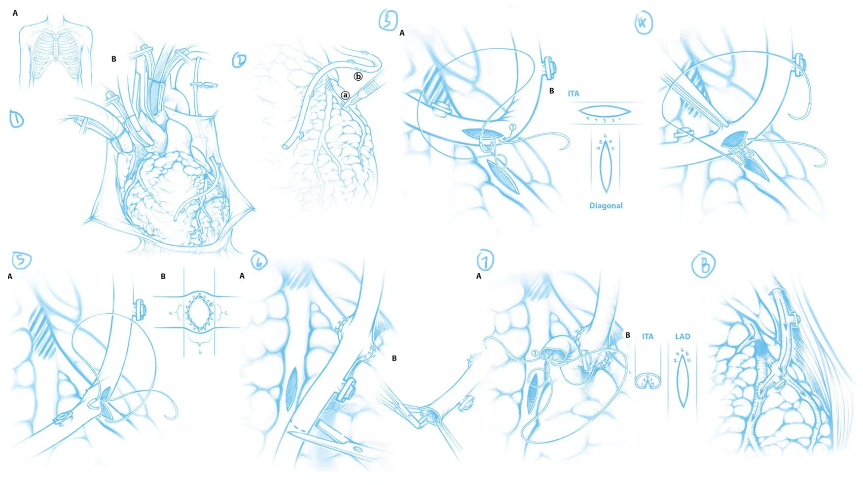 Final sketches of the double coronary bypass surgery process, showing how the surgeon grafts the internal thoracic artery to two sites on the left anterior descending coronary artery.