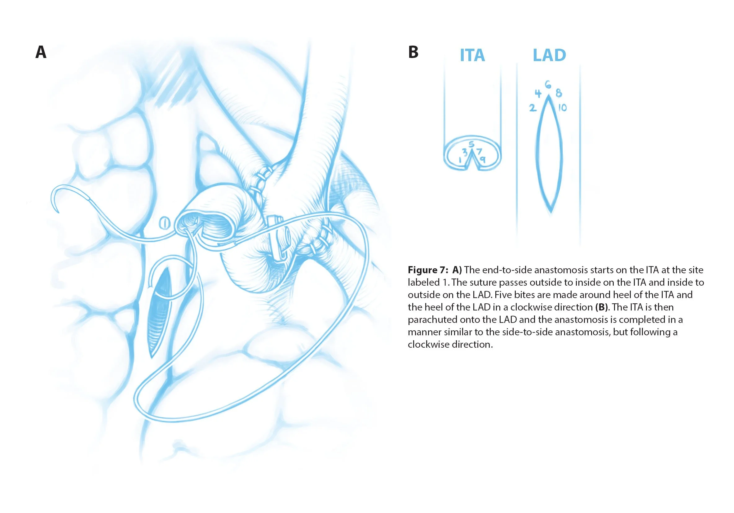 Scientific illustrations of a double coronary artery bypass, a surgical procedure that redirects blood flow around blockages in the coronary arteries. This page shows the suture and stitches used to make the end-to-side anastomosis.
