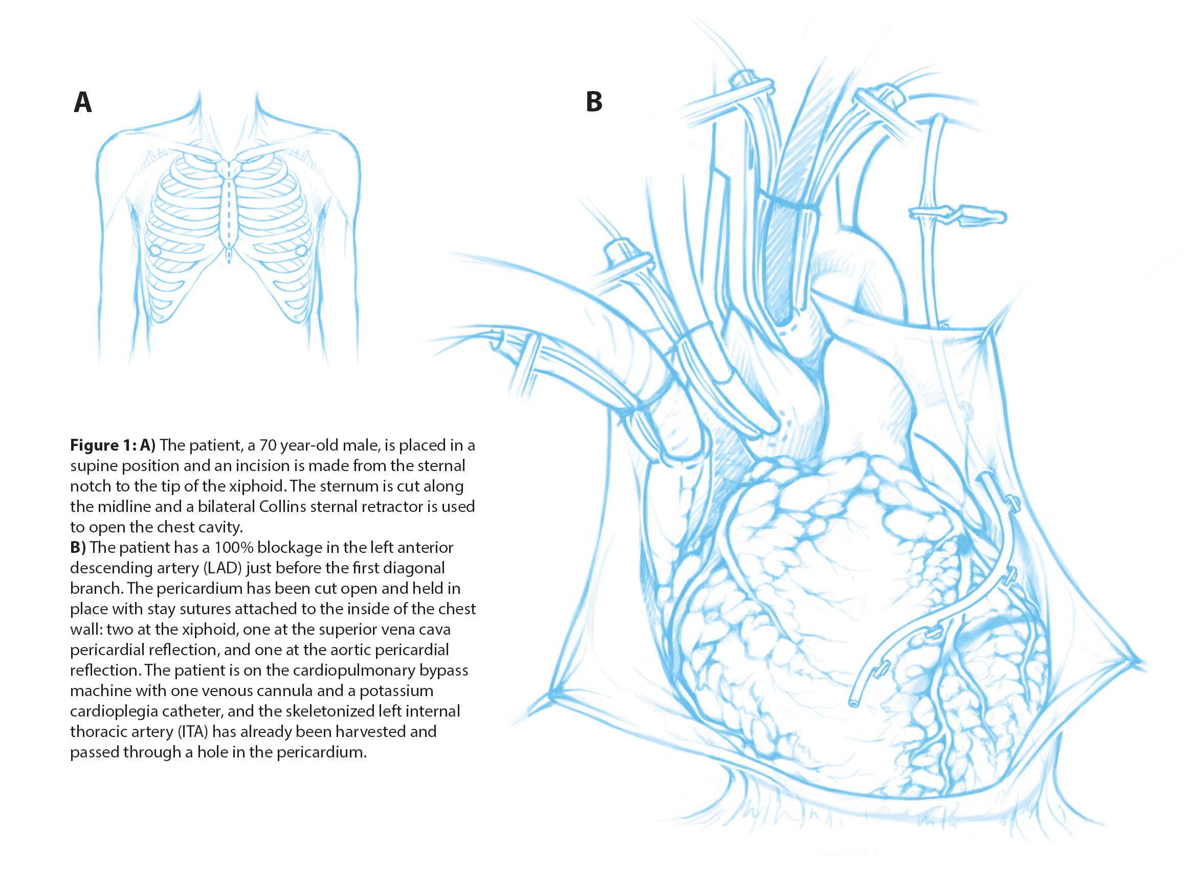 Scientific illustrations of a double coronary artery bypass, a surgical procedure that redirects blood flow around blockages in the coronary arteries. This page has orienting images of the patient, surgical incision, and heart on a cardiopulmonary by