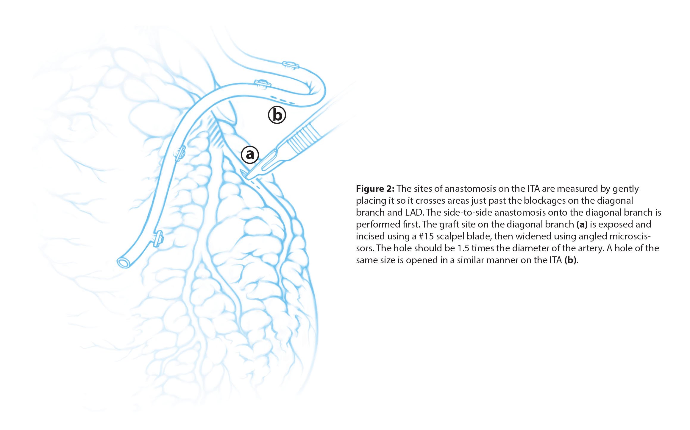Scientific illustrations of a double coronary artery bypass, a surgical procedure that redirects blood flow around blockages in the coronary arteries. This page shows the sites of anastomosis on the internal thoracic artery and left anterior descendi