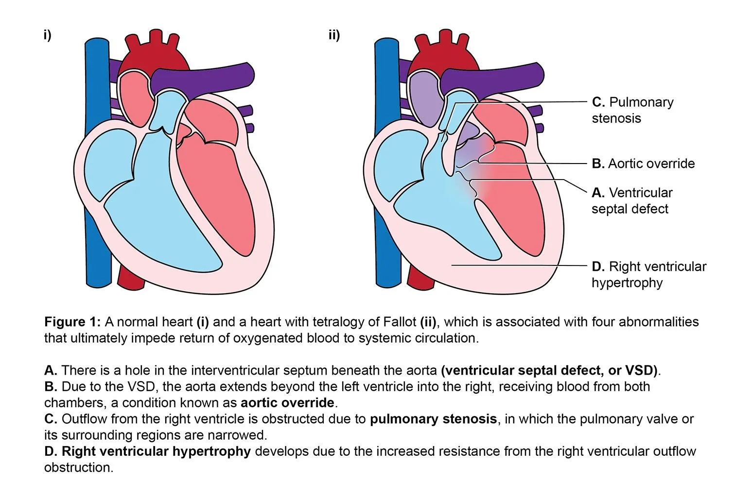 Didactic vector illustrations of the congenital abnormalities associated with tetralogy of Fallot.