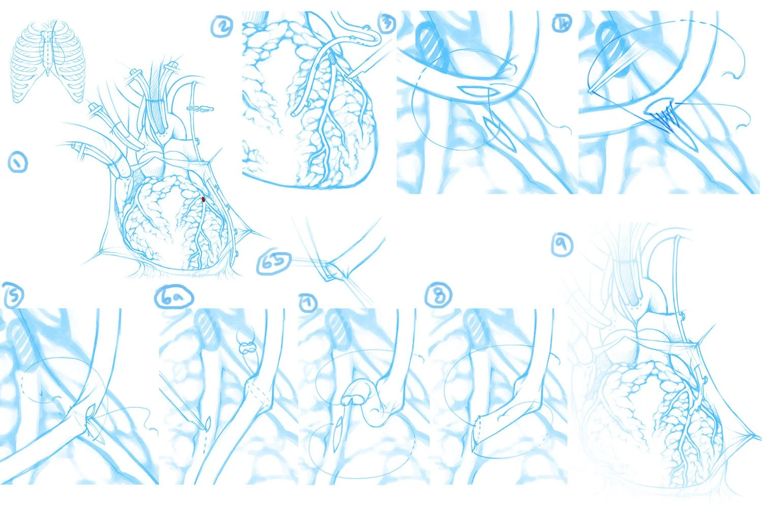 Detailed sketches of the double coronary artery bypass surgery. There is more focus on showing the heart vessels and fat around the surgical site, even when zoomed in. Anastomosis suture patterns are also more detailed.