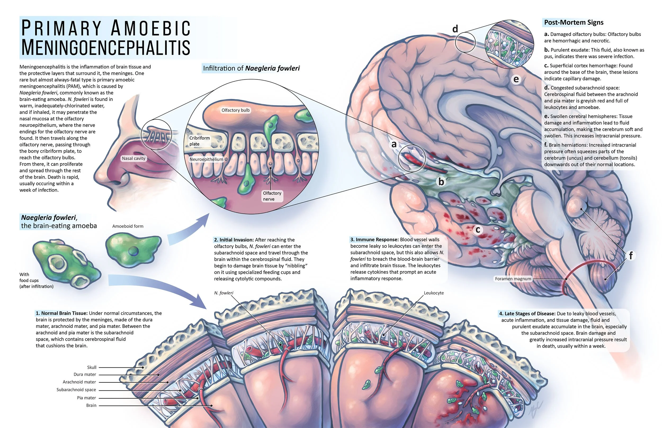 Scientific infographic on primary ameobic meningoencephalitis, a disease caused by the brain-eating amoeba Naegleria fowleri. Pathologies include inflammation of the brain tissue and meninges, leading to brain damage and herniation.
