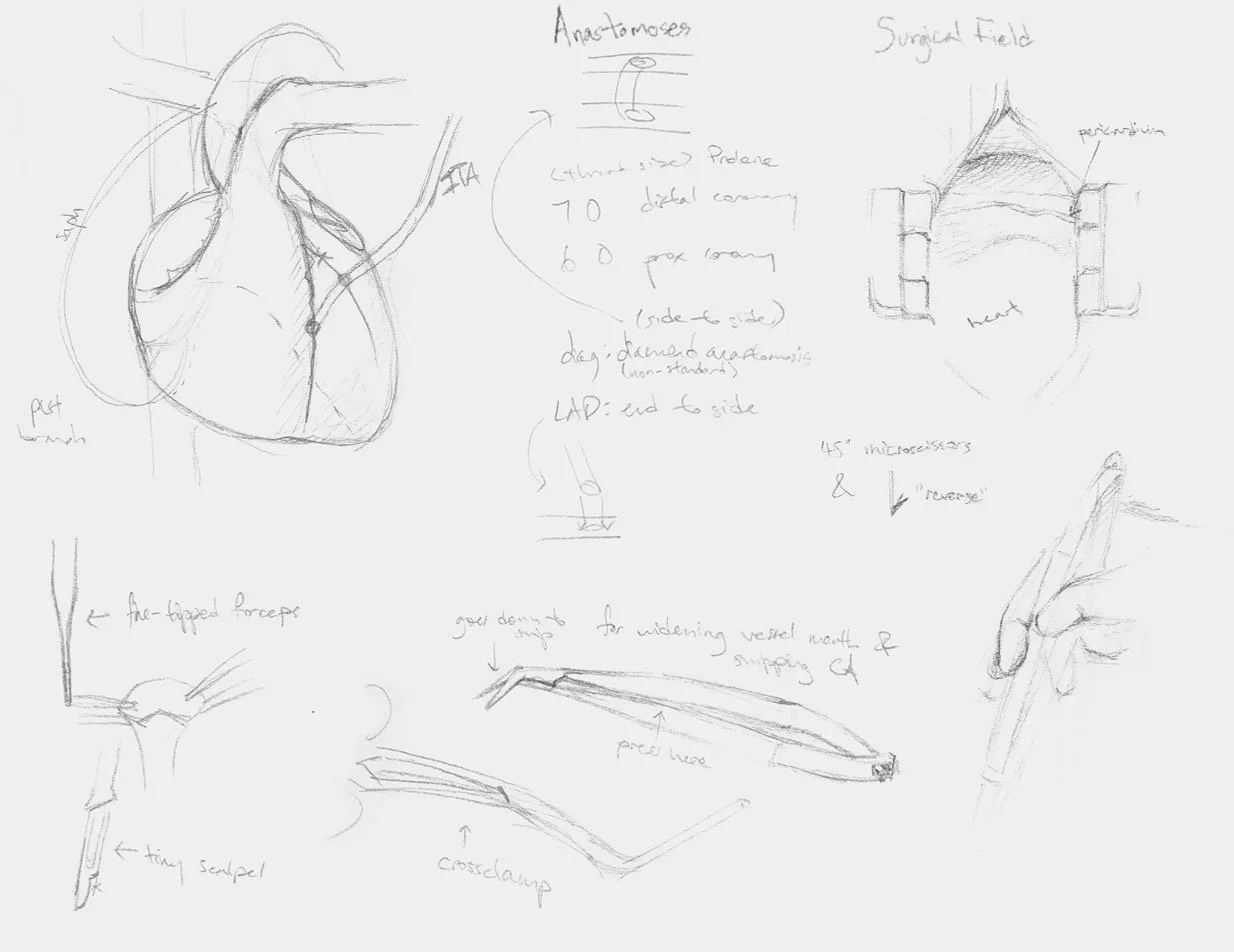 Rough pencil sketches taken while observing the coronary artery bypass surgery in the surgery room. Notes include surgical instruments, sites of anastomoses, surgeon viewpoints, and so on.