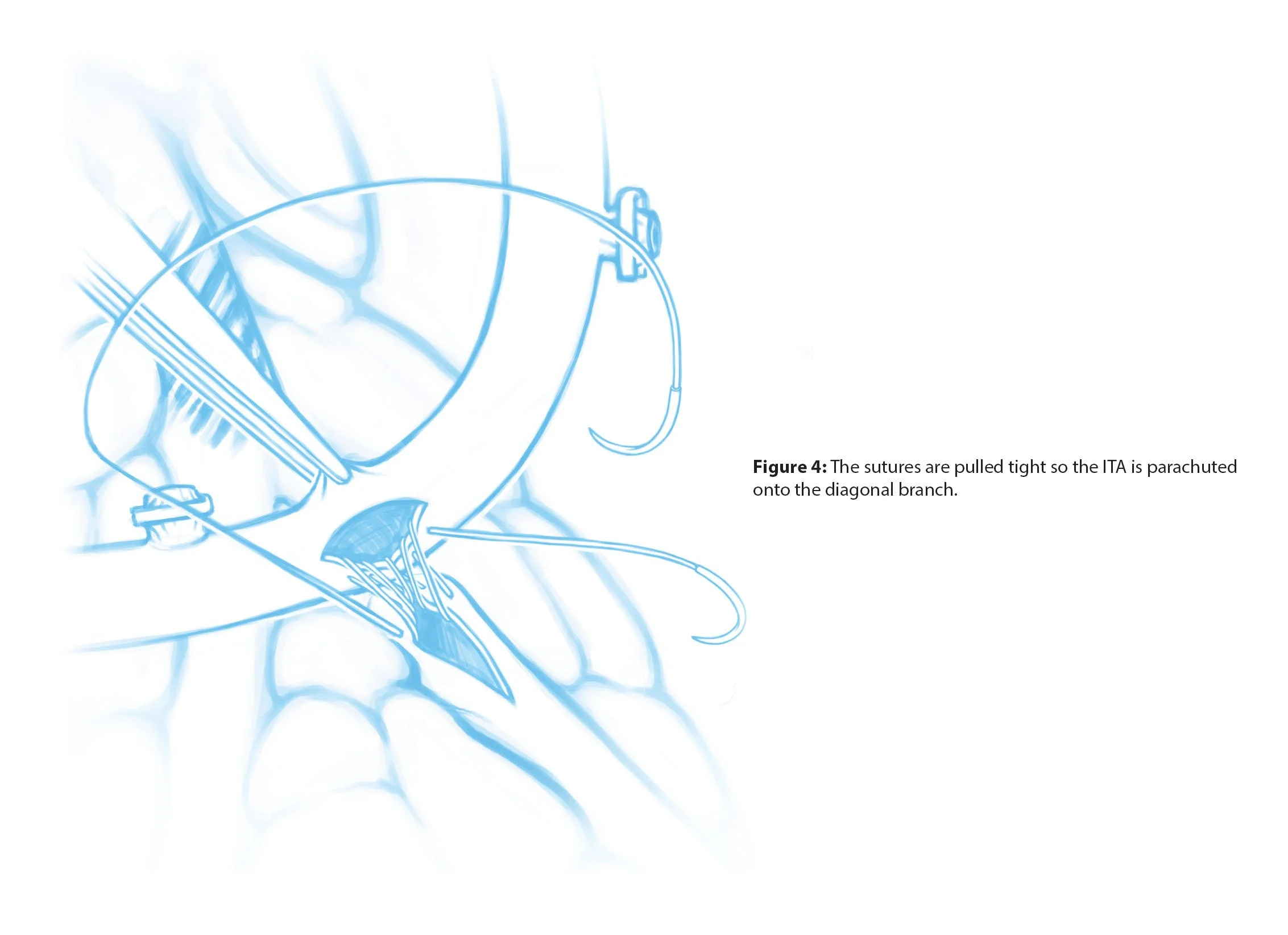 Scientific illustrations of a double coronary artery bypass, a surgical procedure that redirects blood flow around blockages in the coronary arteries. This page shows how the internal thoracic artery is parachuted onto the diagonal branch of the left