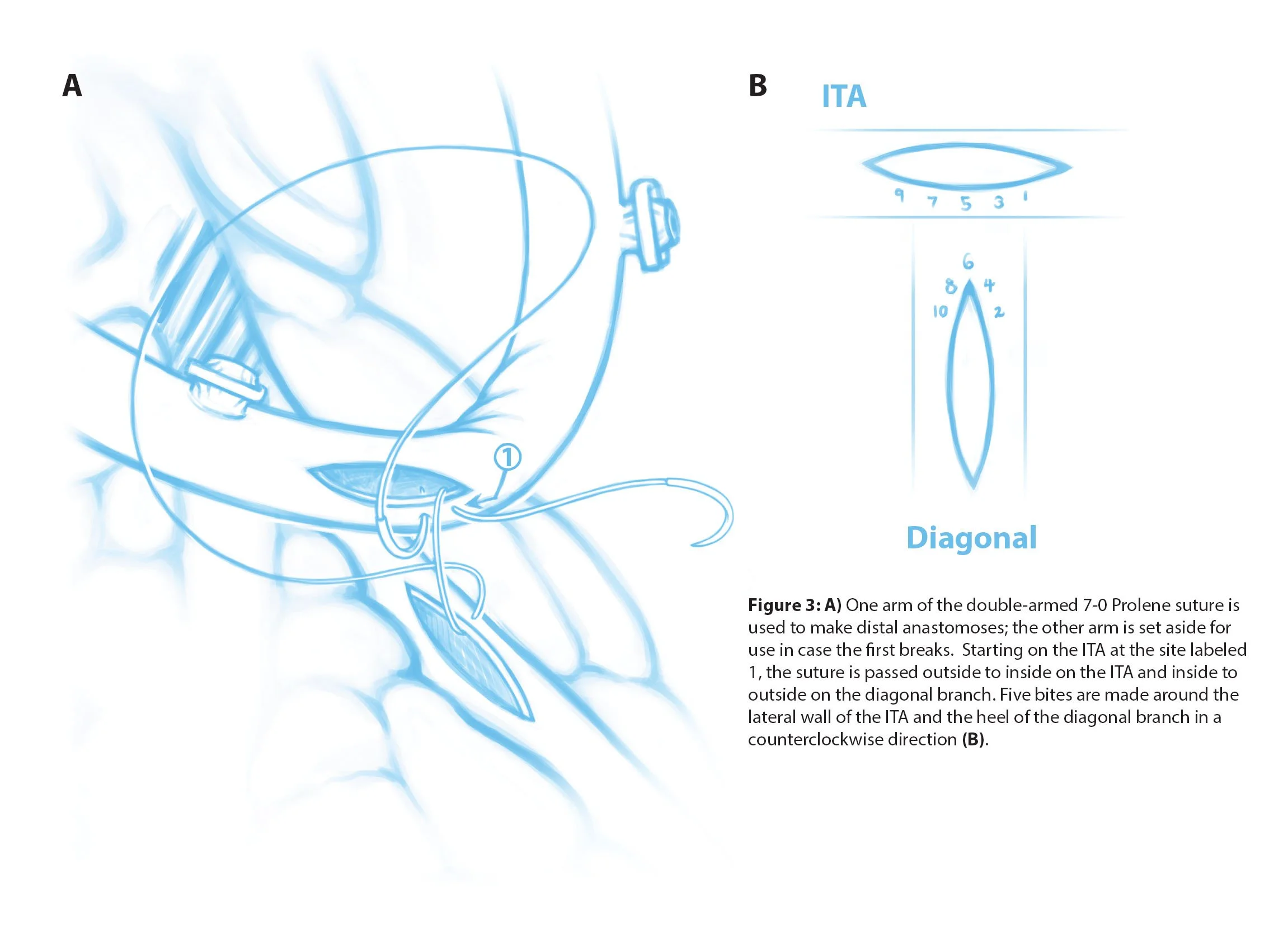 Scientific illustrations of a double coronary artery bypass, a surgical procedure that redirects blood flow around blockages in the coronary arteries. This page shows the suture and stitches used to make the first part of the side-to-side anastomosis