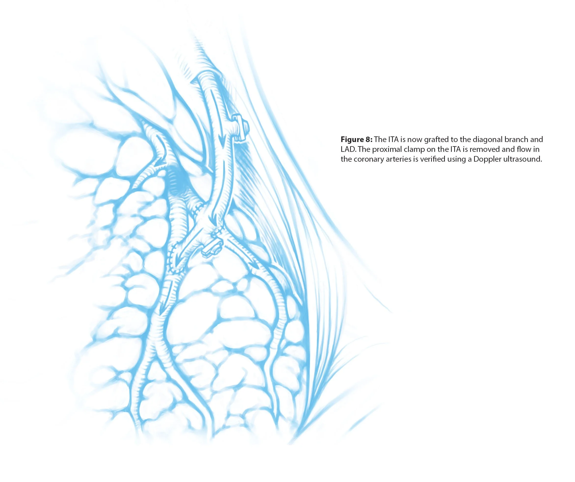 Scientific illustrations of a double coronary artery bypass, a surgical procedure that redirects blood flow around blockages in the coronary arteries. This page shows the completed procedure and the redirected flow of blood.