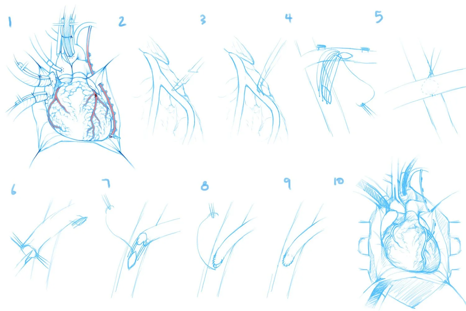 Initial sketches of the double coronary artery bypass surgical procedure. The first and last steps are detailed, while the steps in between are rough, as more research and consultation with the surgeon are needed.
