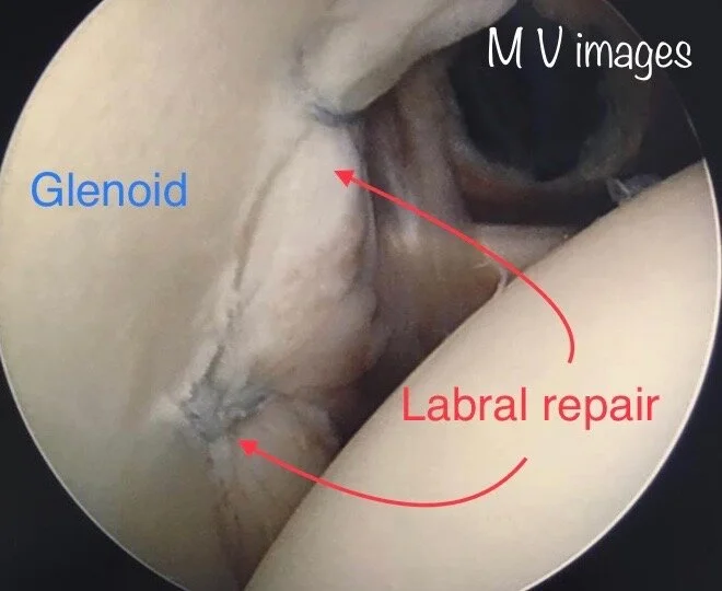labrum repair.jpeg