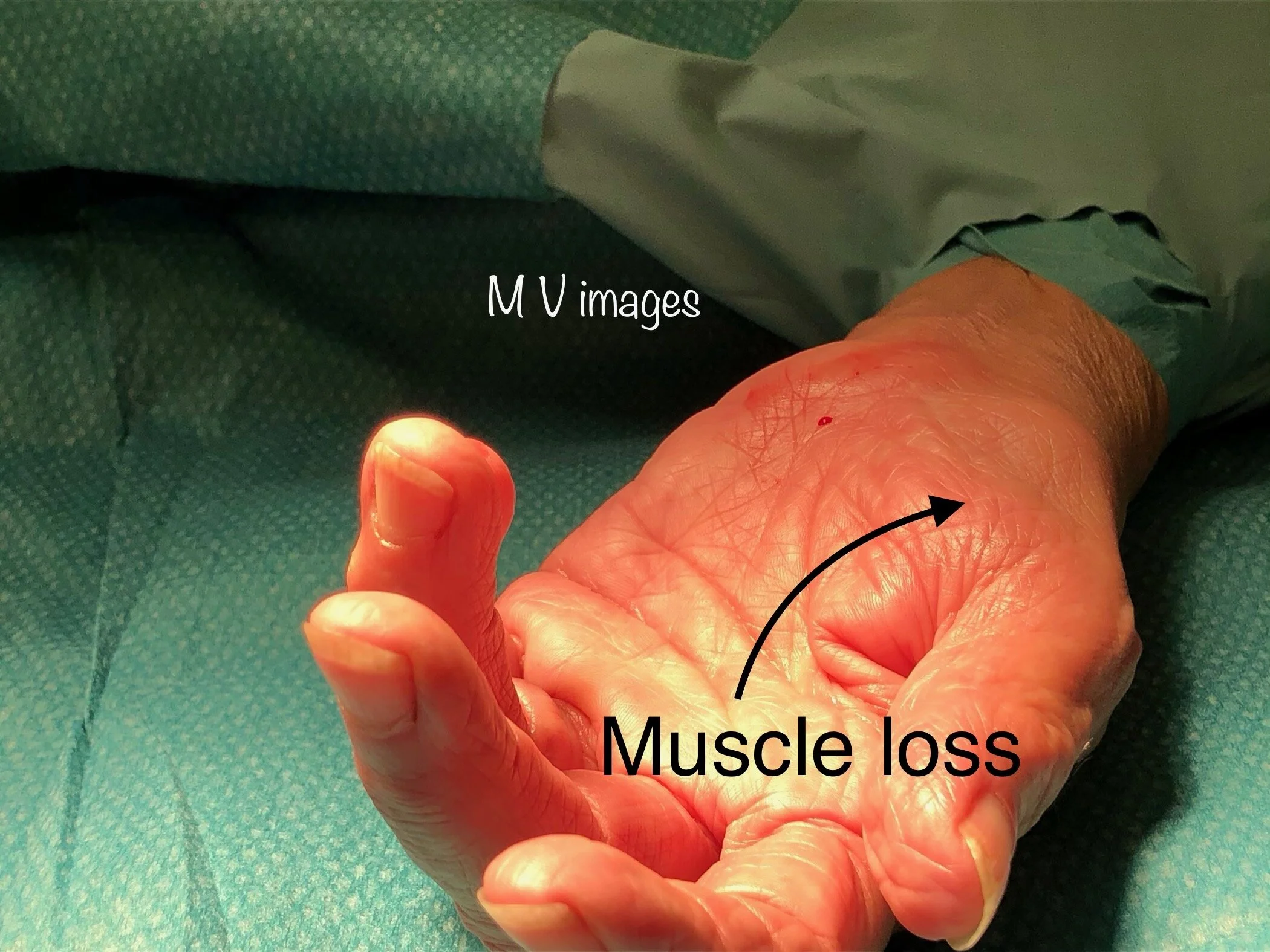 The image above shows muscle waisting around the base of the thumb due to carpal tunnel syndrome.
