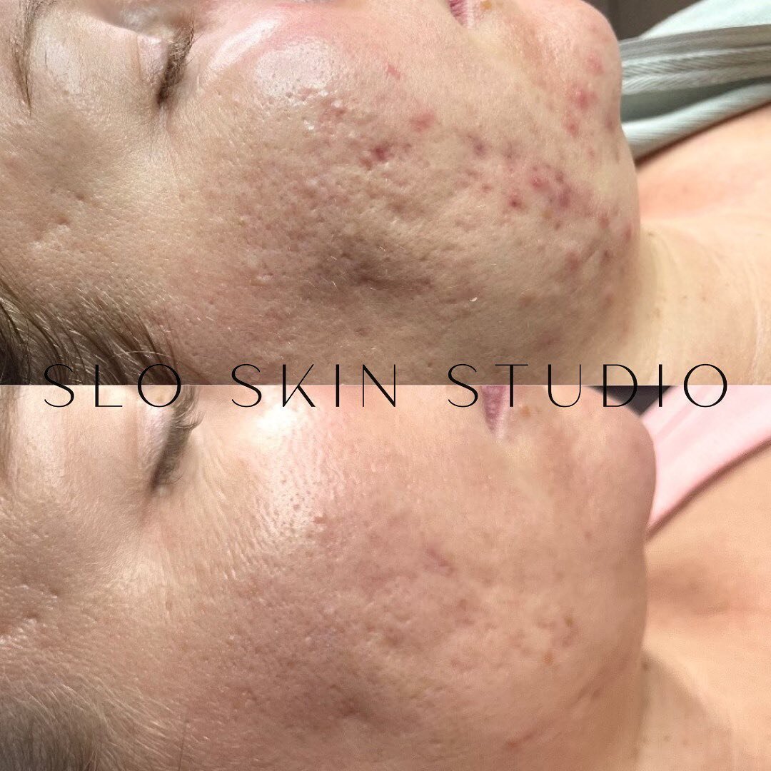 I feel like we haven&rsquo;t hit you guys with a good progress photo in a while&hellip;. 

We cleared her fairly quickly, and while scarring is almost inevitable with this type of acne, we are continuously working on it with different modalities, inc