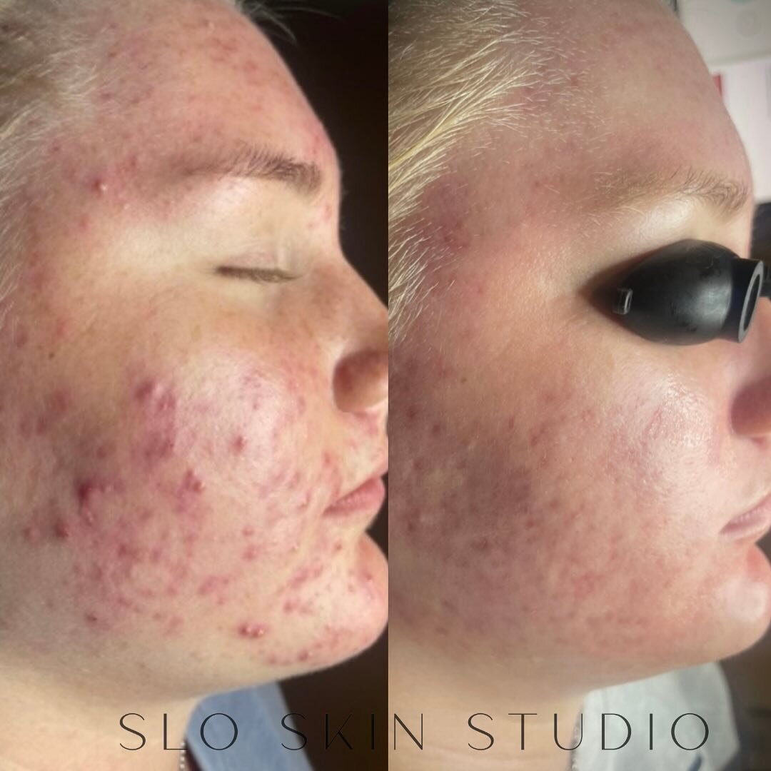 Inflammation who? 🪄Just another acne program graduate! 

Consistent skin care routine and treatments pays off 💪🏻

#skincare #acne #acnetreatment #facerealityskincare #acnespecialist #acnefacial #hydrafacial #facerealityacnespecialist #slo #sloskin