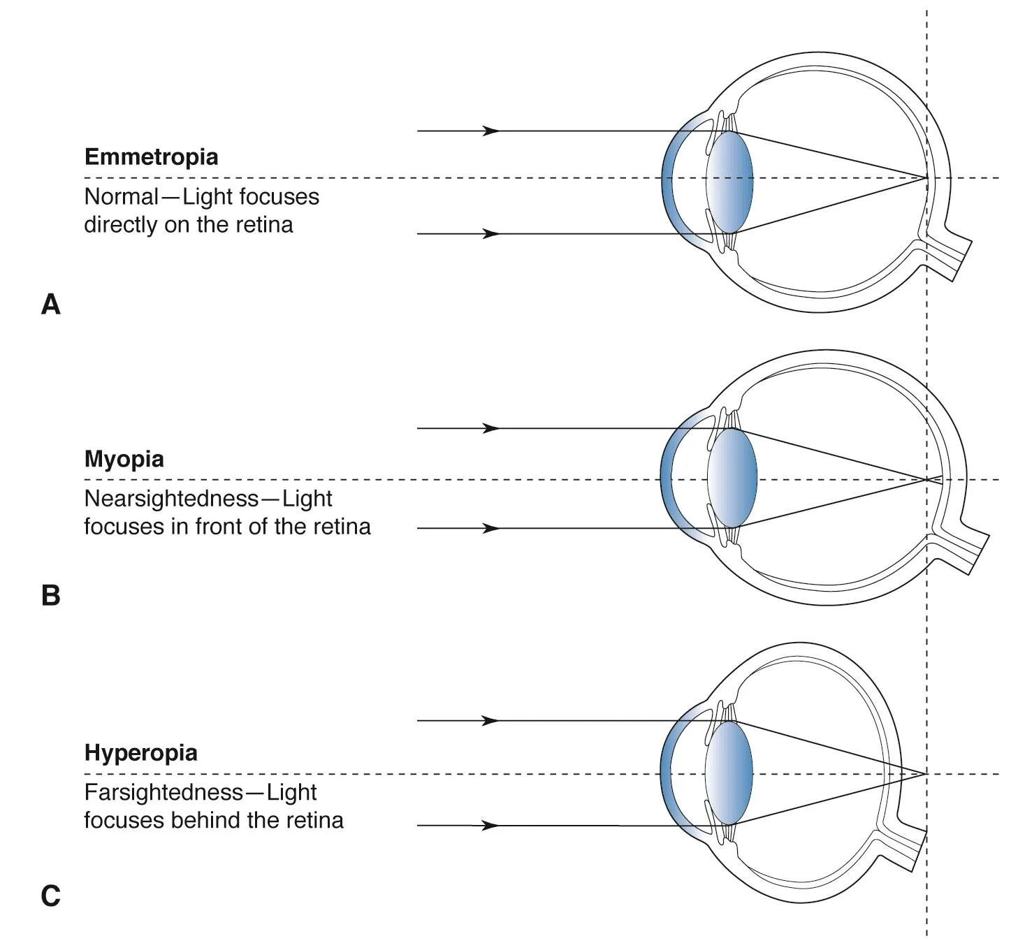 What Is Normal Eye Refraction At Lawrence Henry Blog