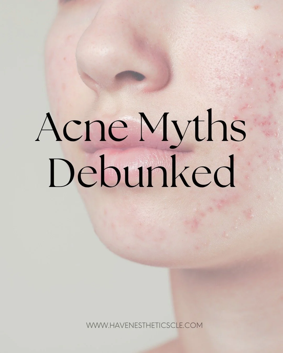 There&rsquo;s so much acne advice out there, but not all of it is true.
We&rsquo;re breaking down a few of the most common myths so you can focus on what really helps your skin. 🩵

Ready for clear, calm skin? Book your Acne Consultation and let&rsqu