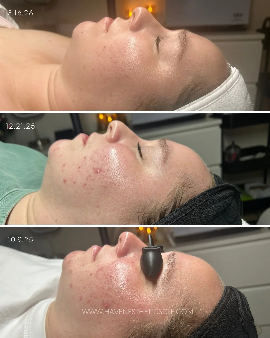 Samantha&rsquo;s progress is such a good reminder that clear skin doesn&rsquo;t always happen overnight! 

Her skin took time, patience, and a few adjustments along the way. We had to shift her routine, pay attention to how her skin was responding, a
