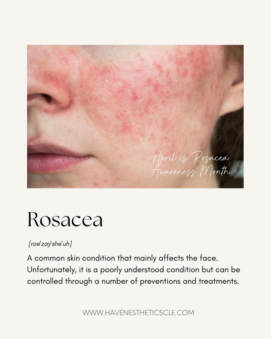 Do you suffer from Rosacea? Not sure what's triggering it or what you can do to treat it?

Unfortunately, this is a commonly misunderstood skin condition that causes chronic inflammation of the skin that can lead to redness, swelling and bumps. Altho