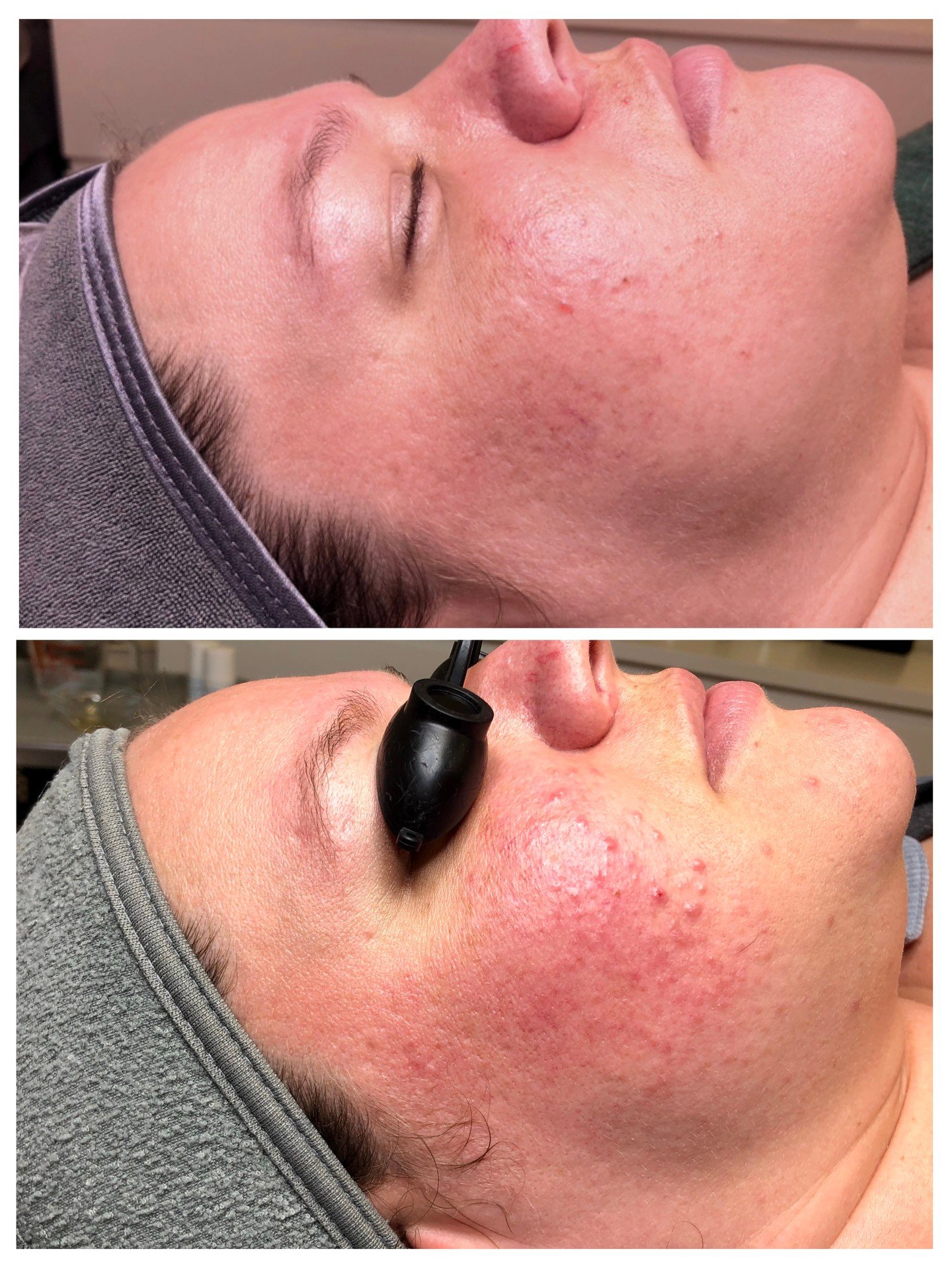 Did you know certain types of rosecea can cause acne?  While the causes and triggers are different from other types of acne, it can still be treated in our Acne Bootcamp program! 

This is Jackie and she was one of our very first acne clients!  She w