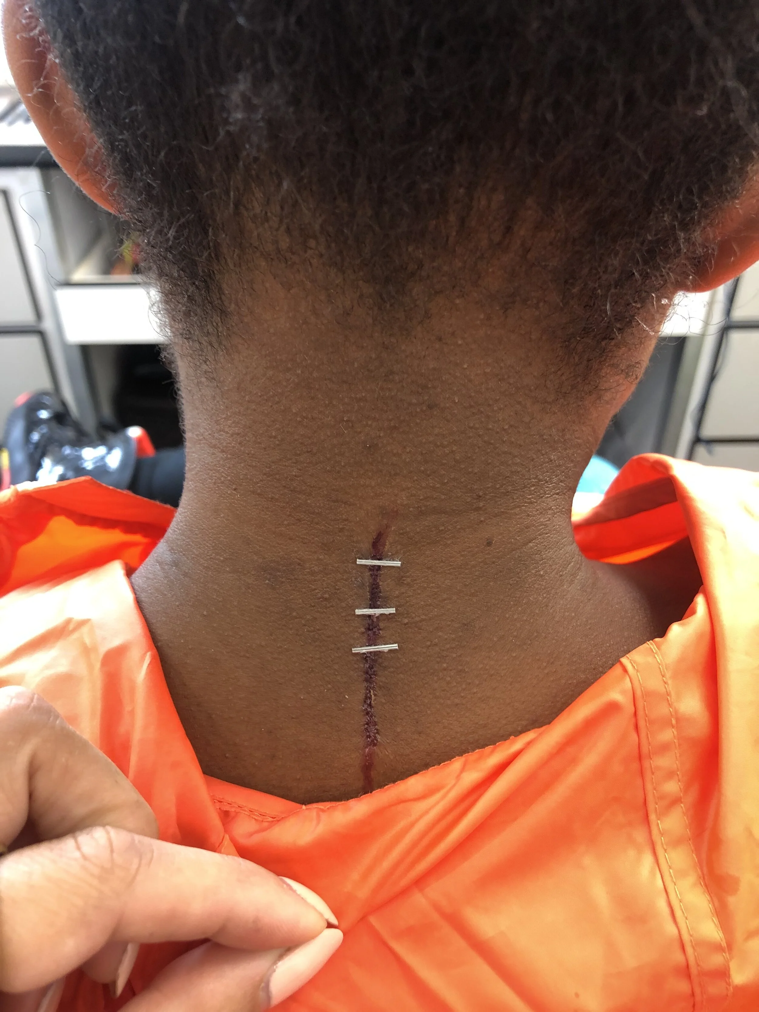 Staple Suture