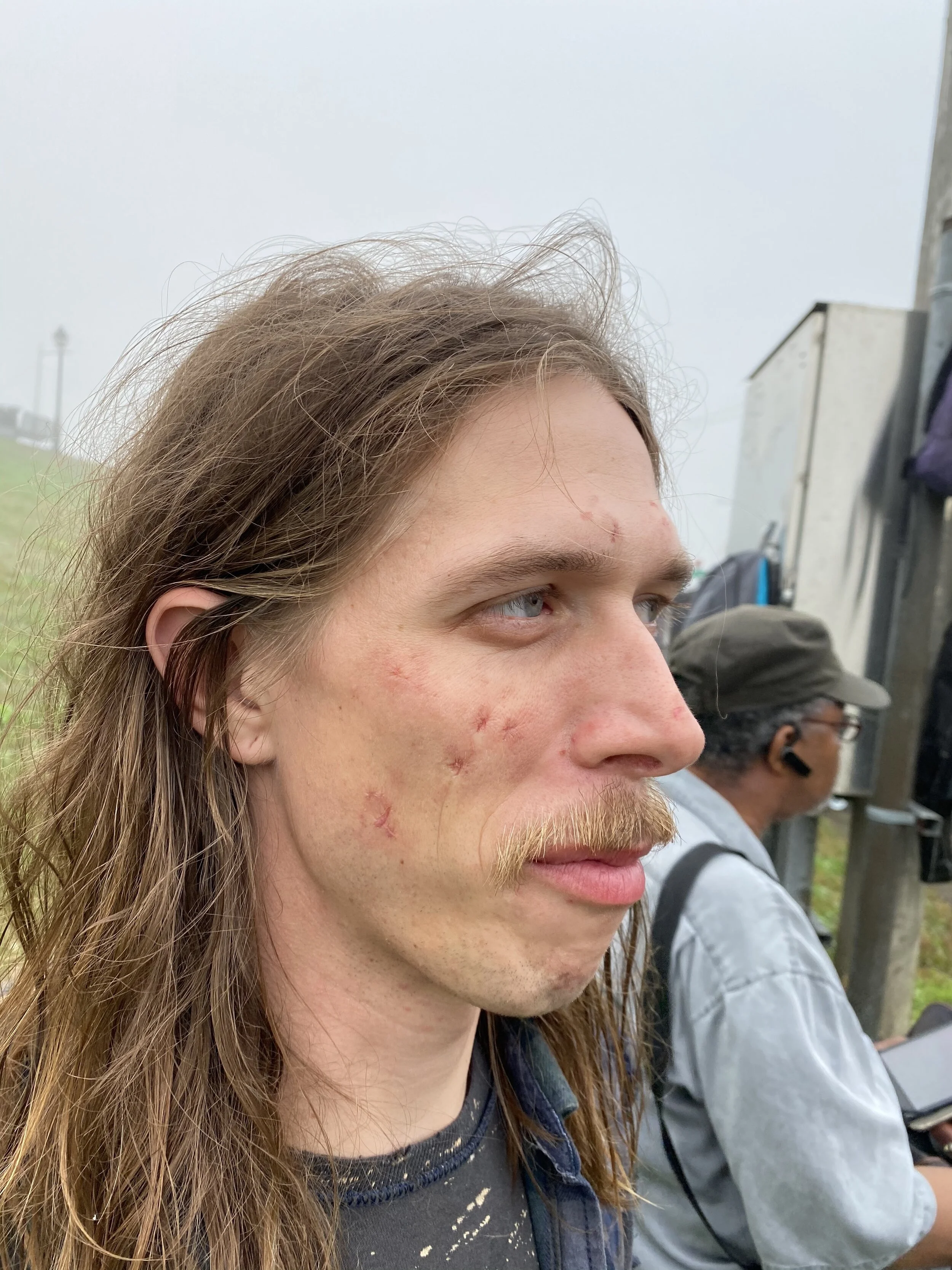 Drug User Acne Scarring
