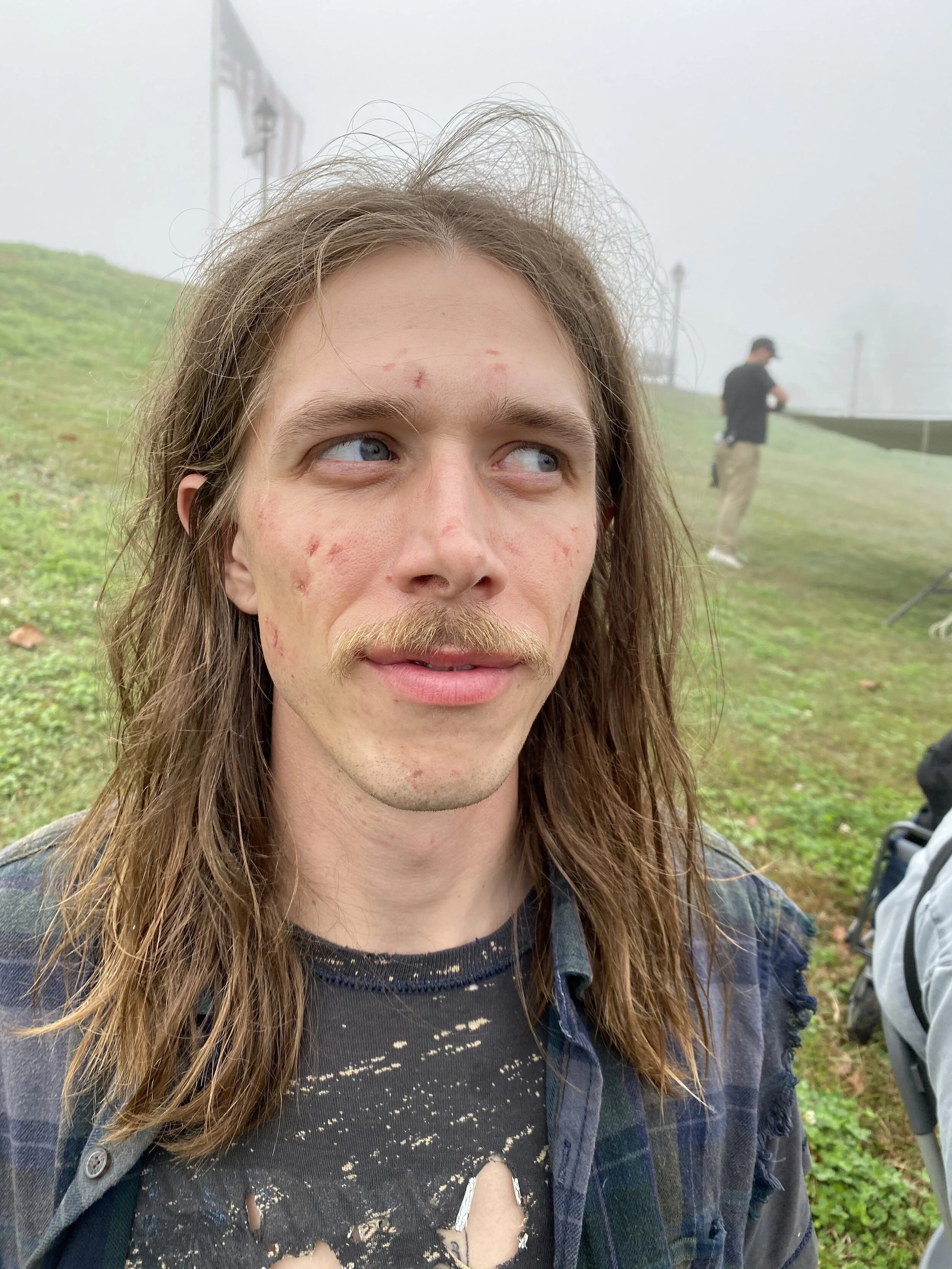 Drug User Acne Scarring