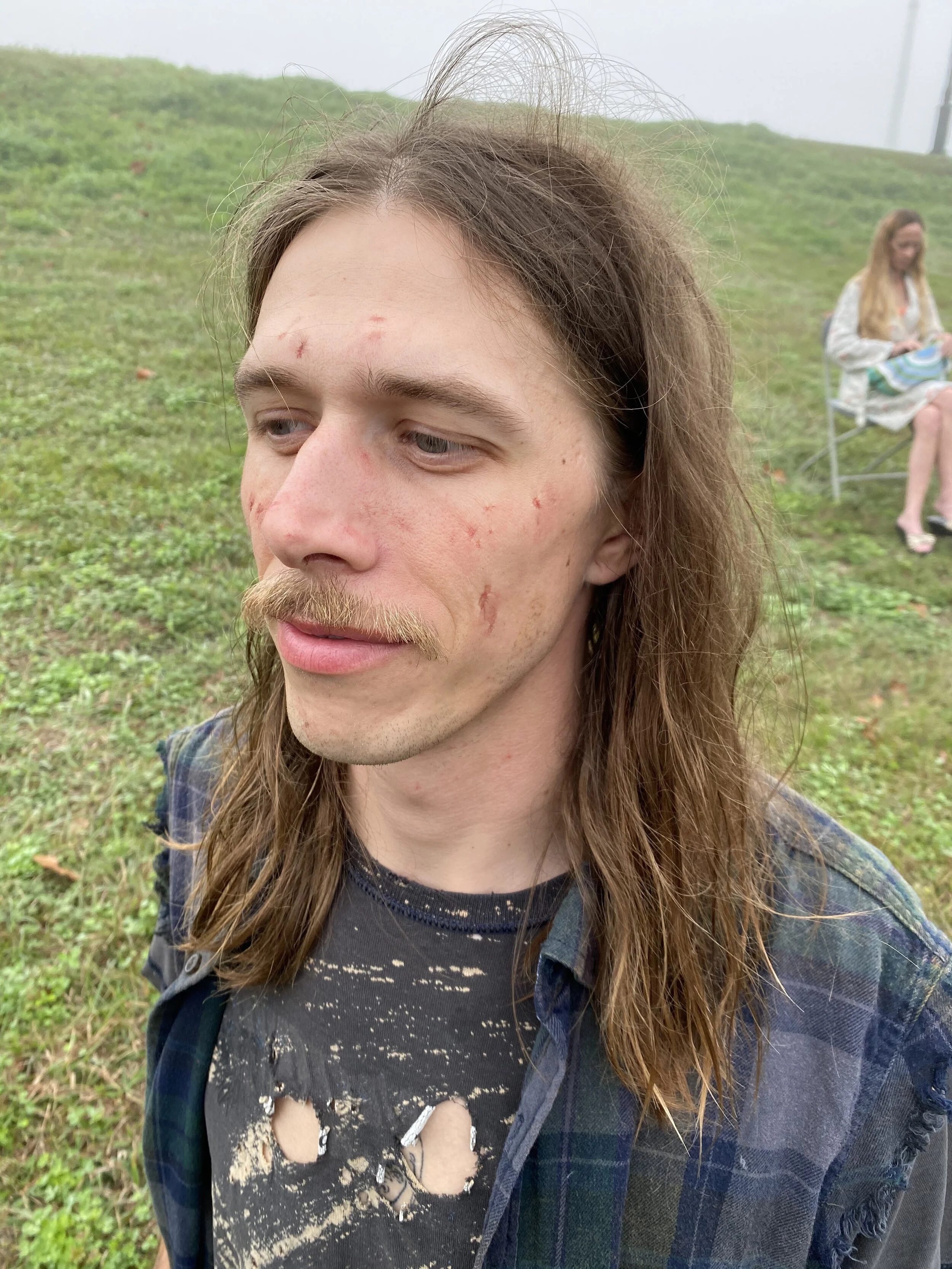 Drug User Acne Scarring
