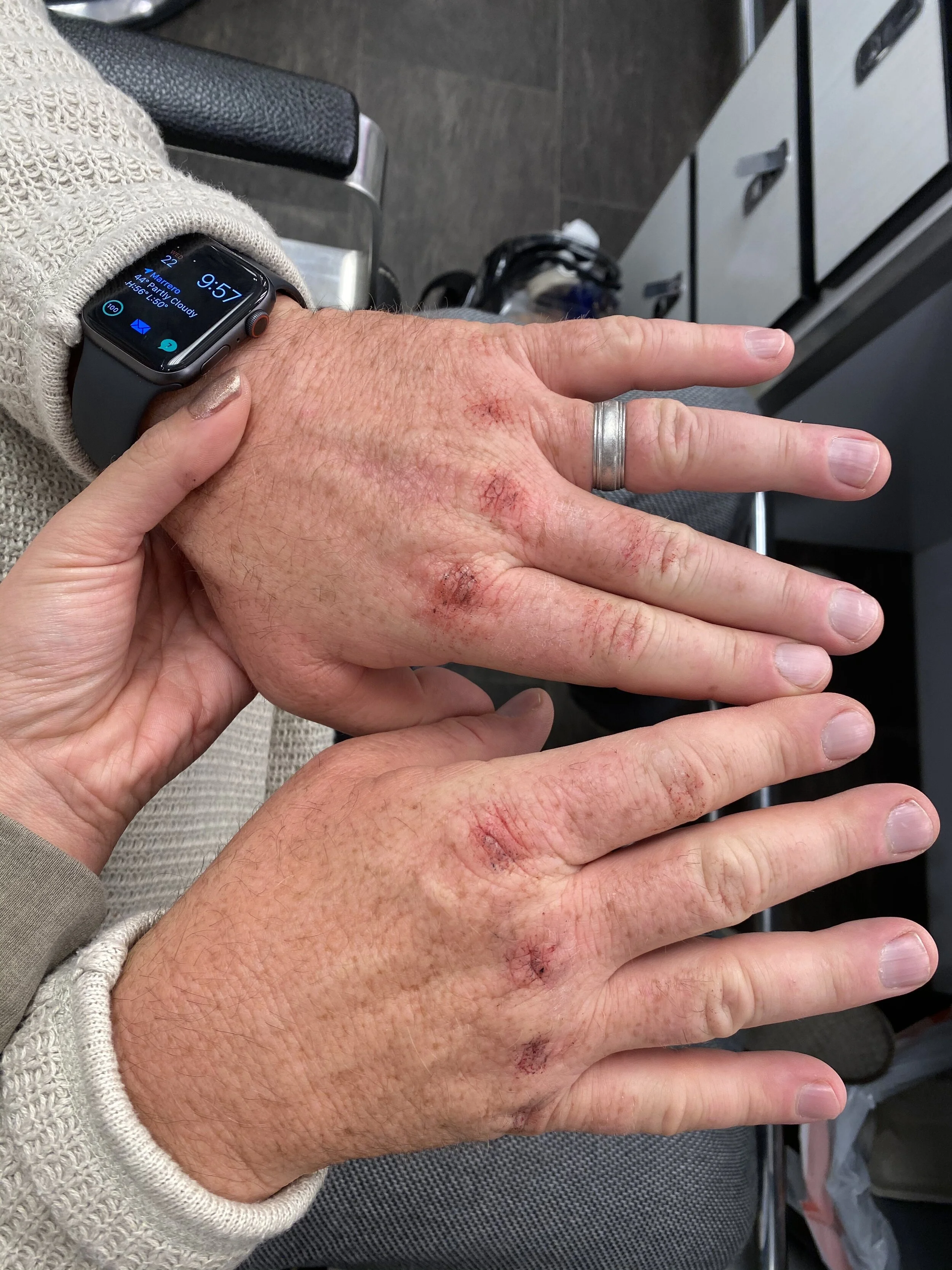 Bloody Knuckles