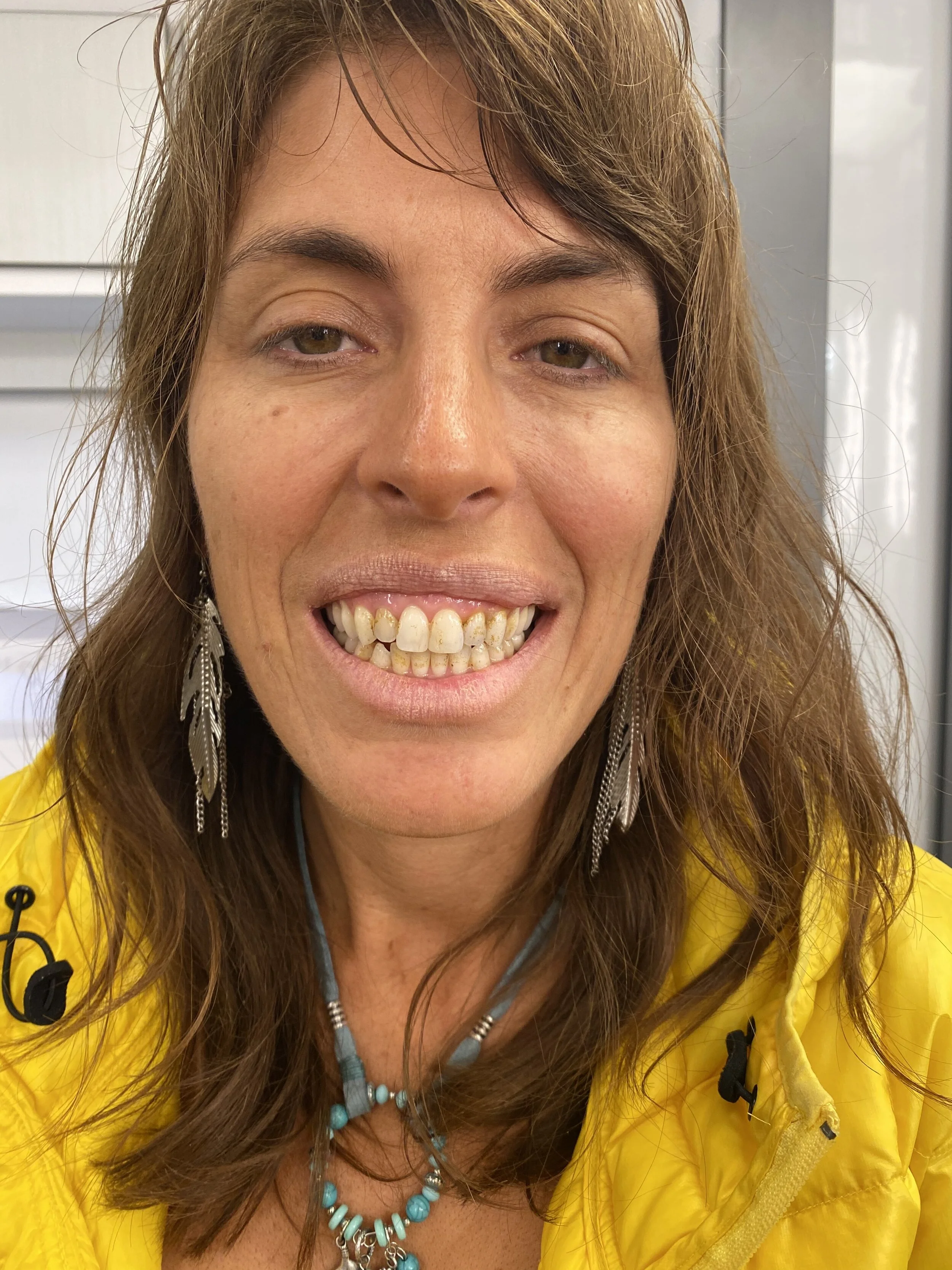 Decaying Teeth