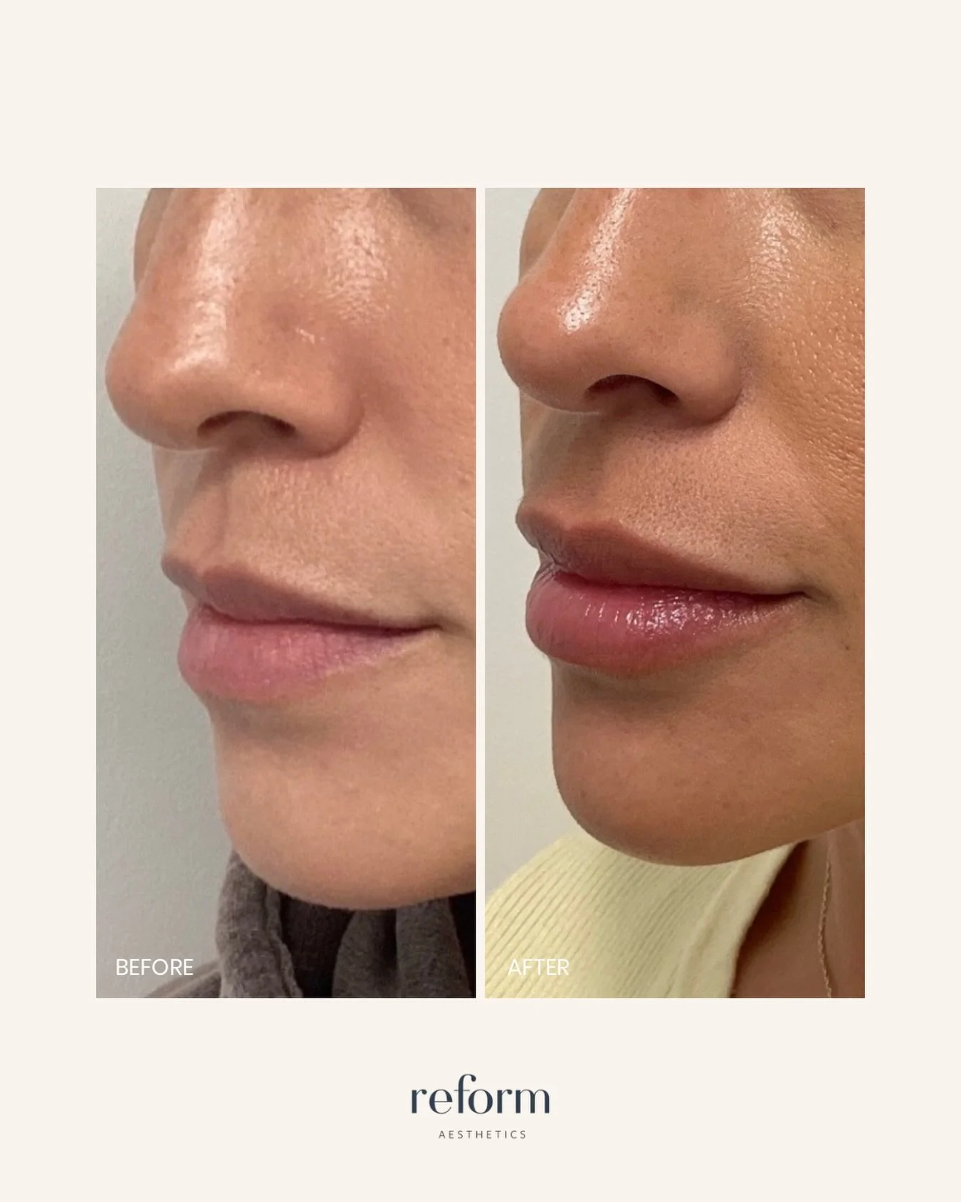 4 years apart, multiple lip filler treatments in between, zero migration. ✨

When lip filler is done using the right technique and the right filler, we can repeat treatments as it metabolizes over time without any concern of migration or an unnatural