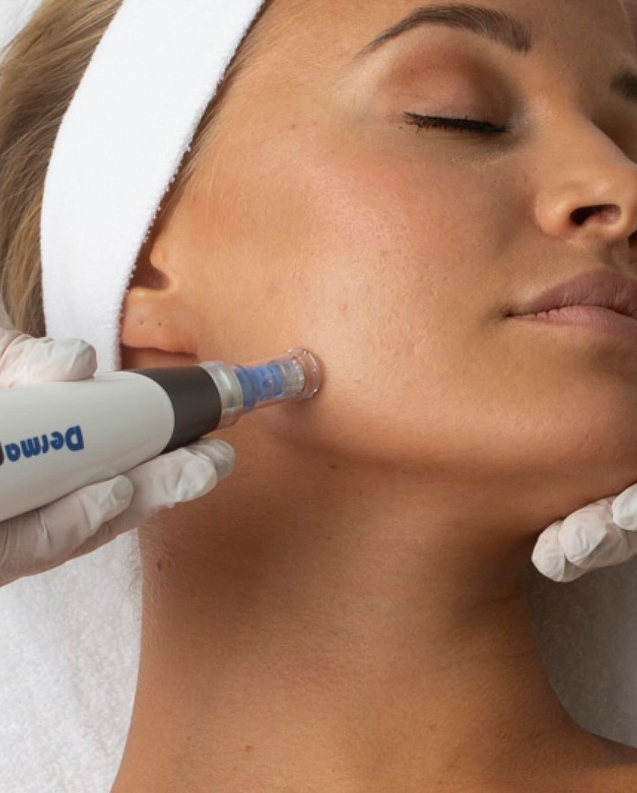 &ldquo;Say goodbye to dull skin! Dermapen microneedling naturally boosts collagen, delivers healing nutrients, and gives you plumper, younger-looking skin. 

A full consultation is provided to ensure this is right for you. 

Our most popular treatmen