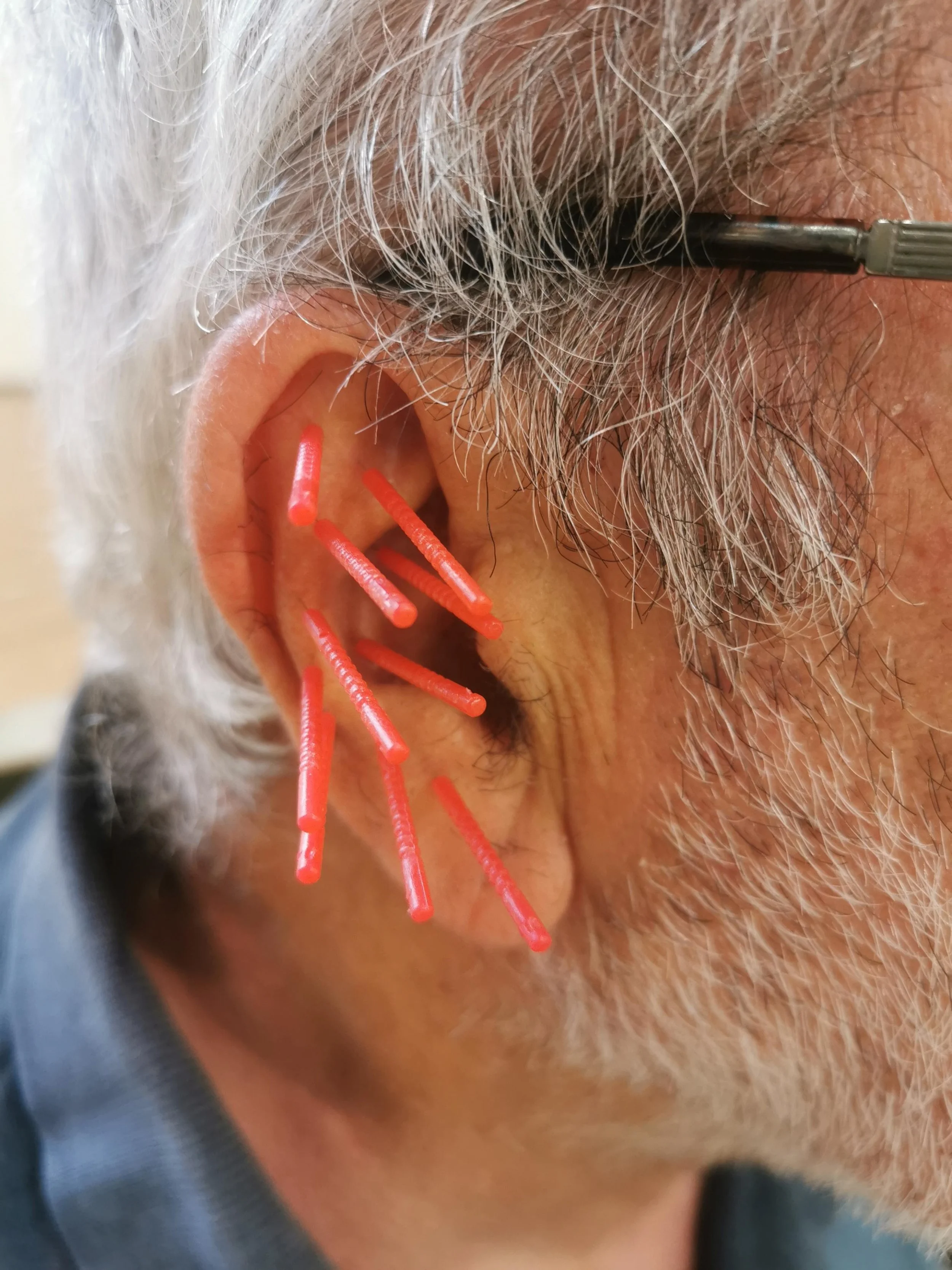 Acupuncture For Chronic Back Pain