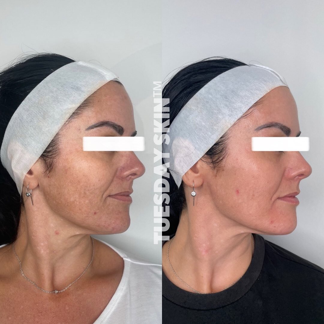 Here we have results from just 1 BBL + Moxi with Cass ⚡️⚡️⚡️ Look at that pigment reduction, overall skin clarity/glow and the vessels around her nose!

We&rsquo;ve also diagnosed a likely Filaggrin gene deficiency* with this client and we&rsquo;ve i