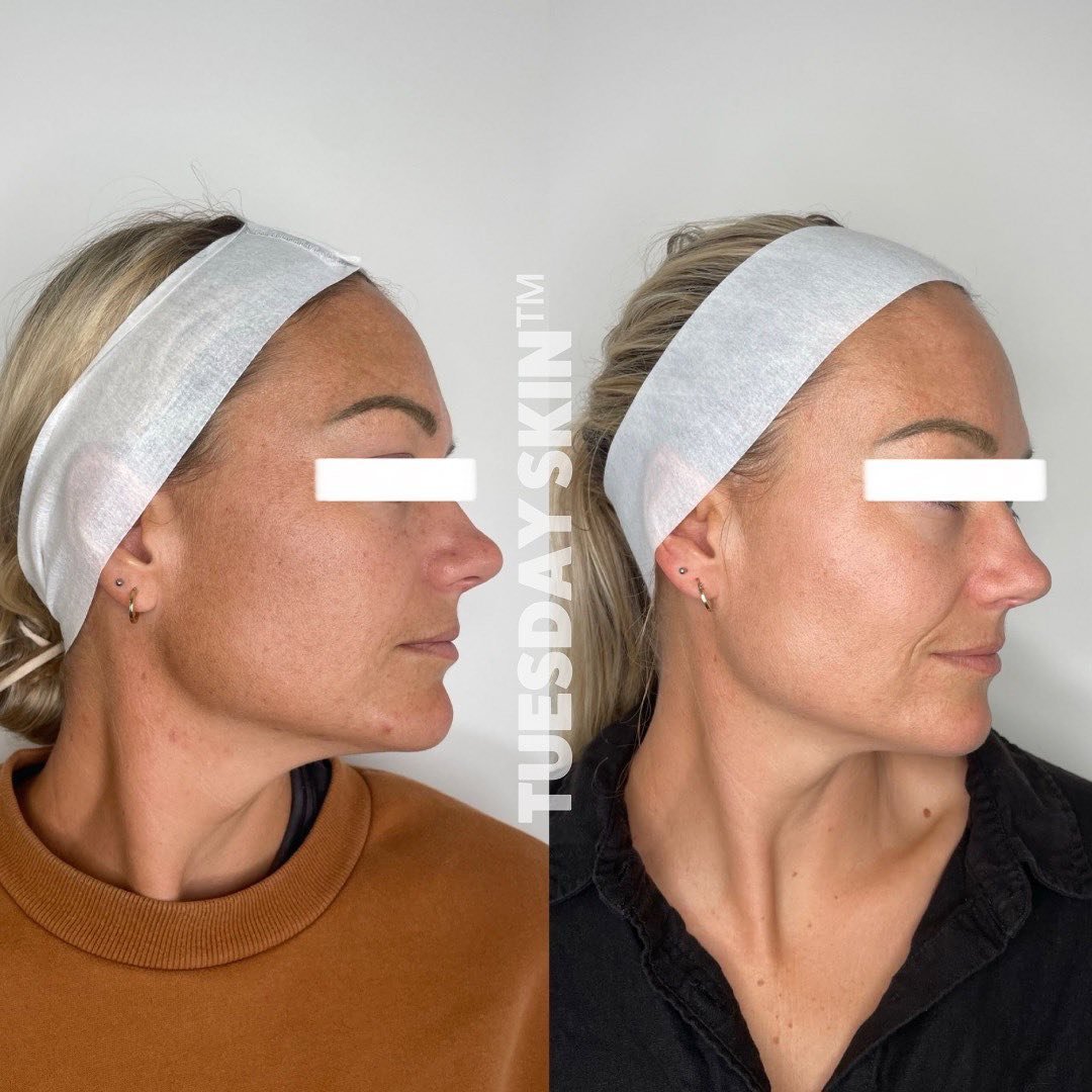 We&rsquo;re investing your money where it matters, treatments that yield results and actually work&hellip;
This baddie travelled from Whangarei for us to safely treat her Melasma with a darker skin typing and history, leaving with a more even complex