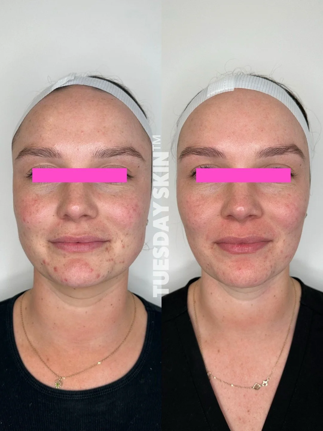 The Tuesday effect, just six months between photos with Krissy&rsquo;s skin health and over all face shape transformed. Let us happen to you too 🫶🏻