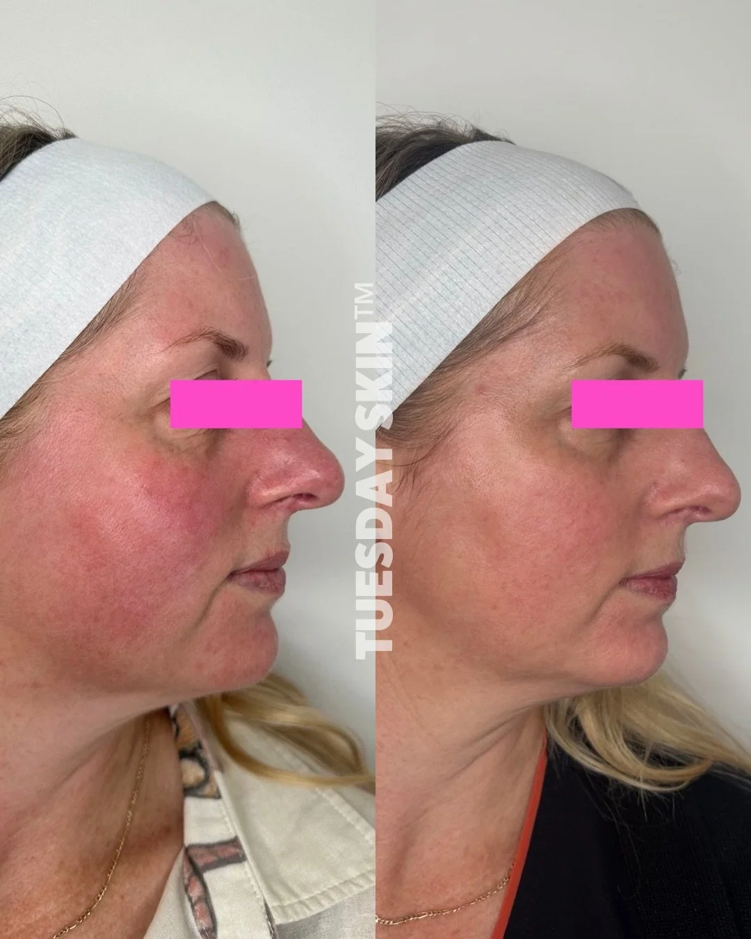 How this for redness reduction? 2 months of consistent Dermaviduals skincare to repair the skin barrier and reduce inflammation and just ONE skin needling treatment to strengthen the skin and help reduce the appearance of  vascular activity 🫶🏽