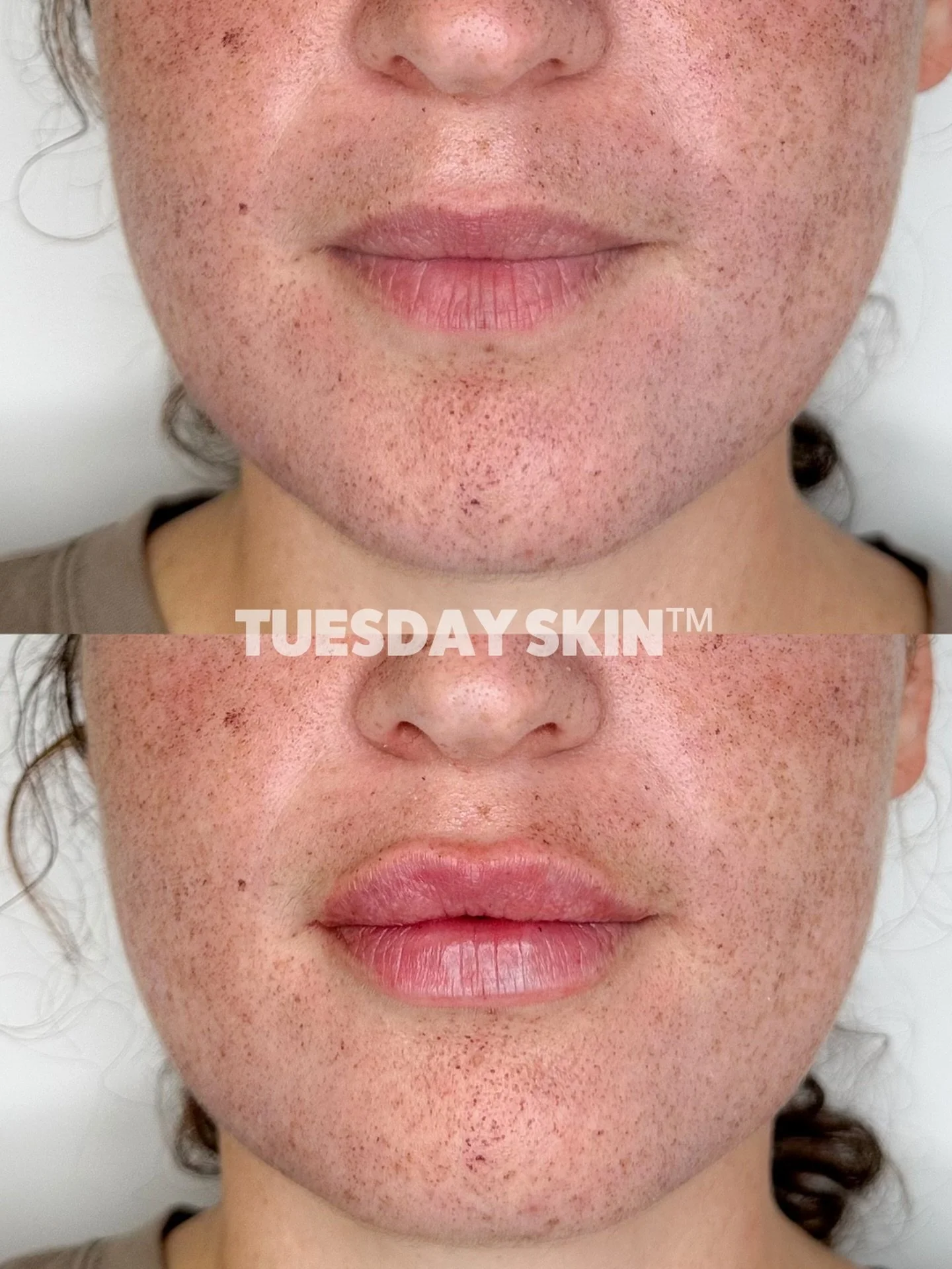 Lips by Stevie! - It&rsquo;s safe to say our girl is an absolute natural! Above is pre and below is immediately post lip filler 🫦🫦 We&rsquo;ve also got day two &ldquo;mends&rdquo; and pigment from BBL + Moxi on display for this baddie&hellip; we&rs