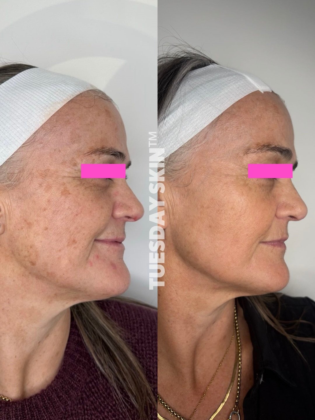 When someone doesn&rsquo;t believe in the power of Broadband Light (BBL) and Dermaviduals &ndash; we show them how it&rsquo;s done because we refuse to have disappointed clients 🤌🏽

Literally turning the clock back with a little vid to come about t