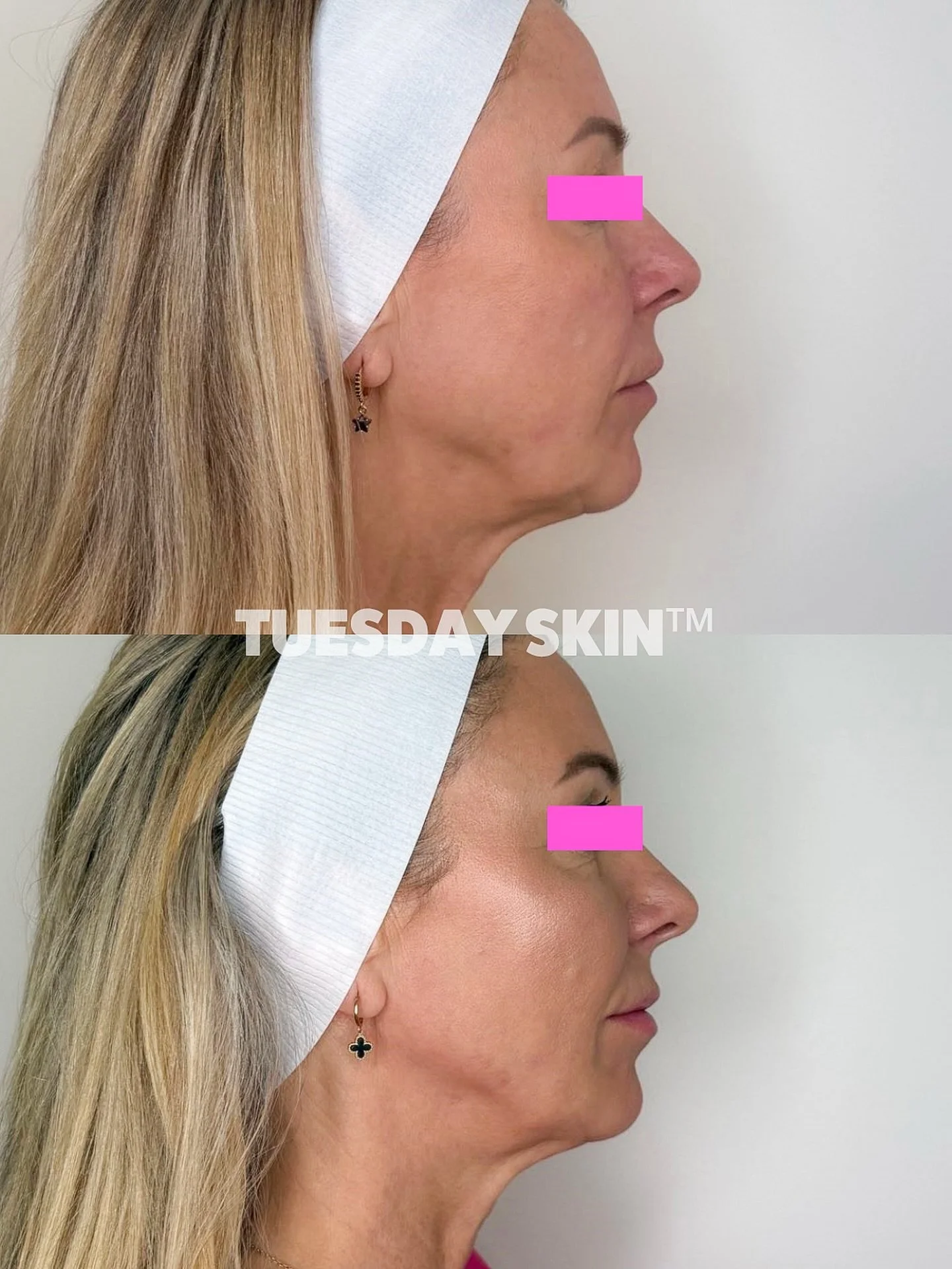 I&rsquo;ll hold your hand when I tell you that lower face almost always requires support higher up. 
This before and after showcases exactly that, you can visibly see how the added volume to her temples, cheekbone and jawline have defined and lifted 