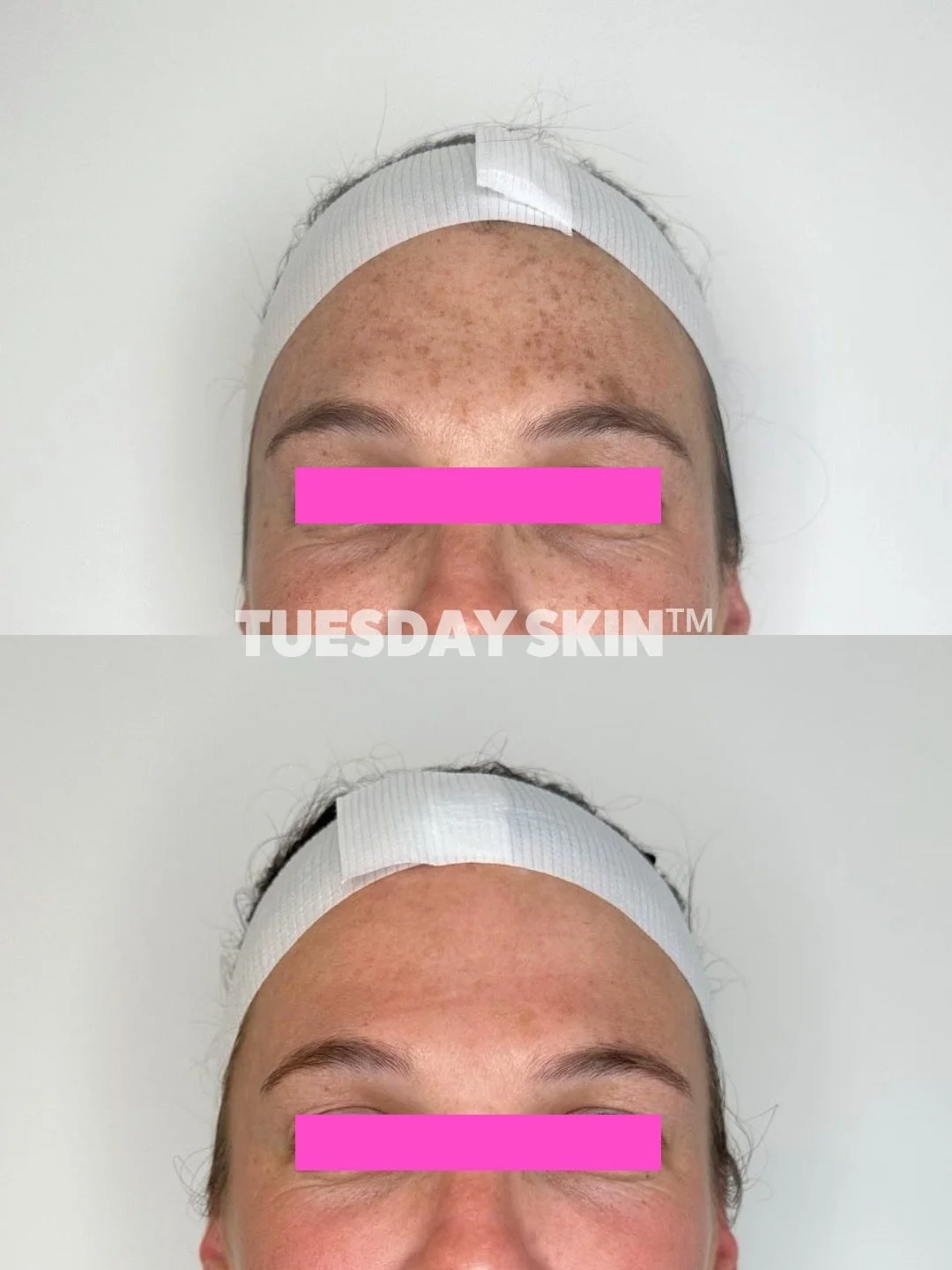 &ldquo;Proud of my results&rdquo; - a literal clean slate on freckles and sun damage 🪄

This brave baddie messaged us with permission to share her incredible before &amp; afters because everyone deserves to see what&rsquo;s possible with BBL/Moxi. 
