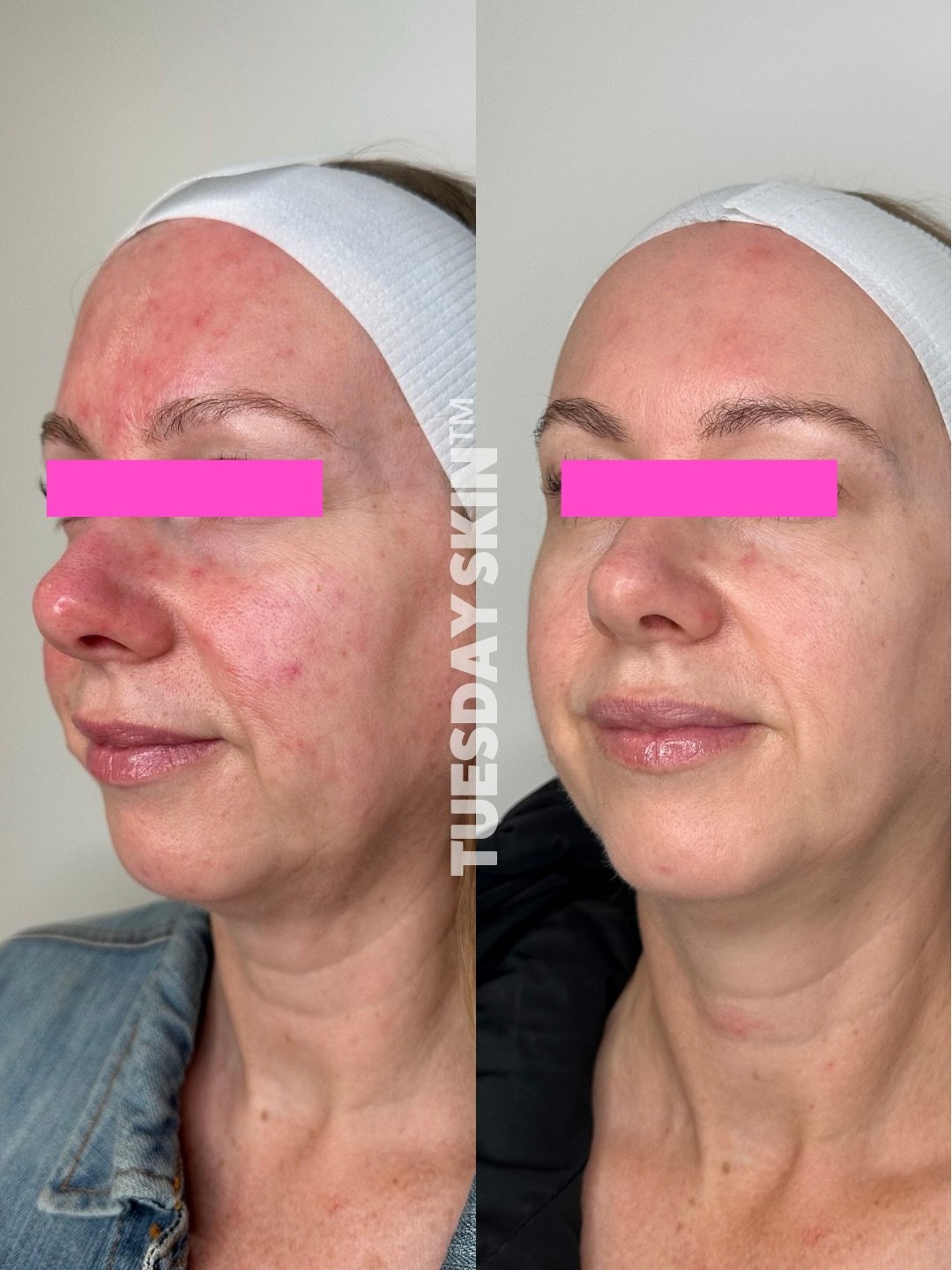 Skin like this doesn&rsquo;t happen by accident.

&ldquo;One year of focusing on my skin health journey through menopause and rosacea. A huge thank you to Tuesday Skin Studio for helping transform my skin with broadband light therapy, red light thera