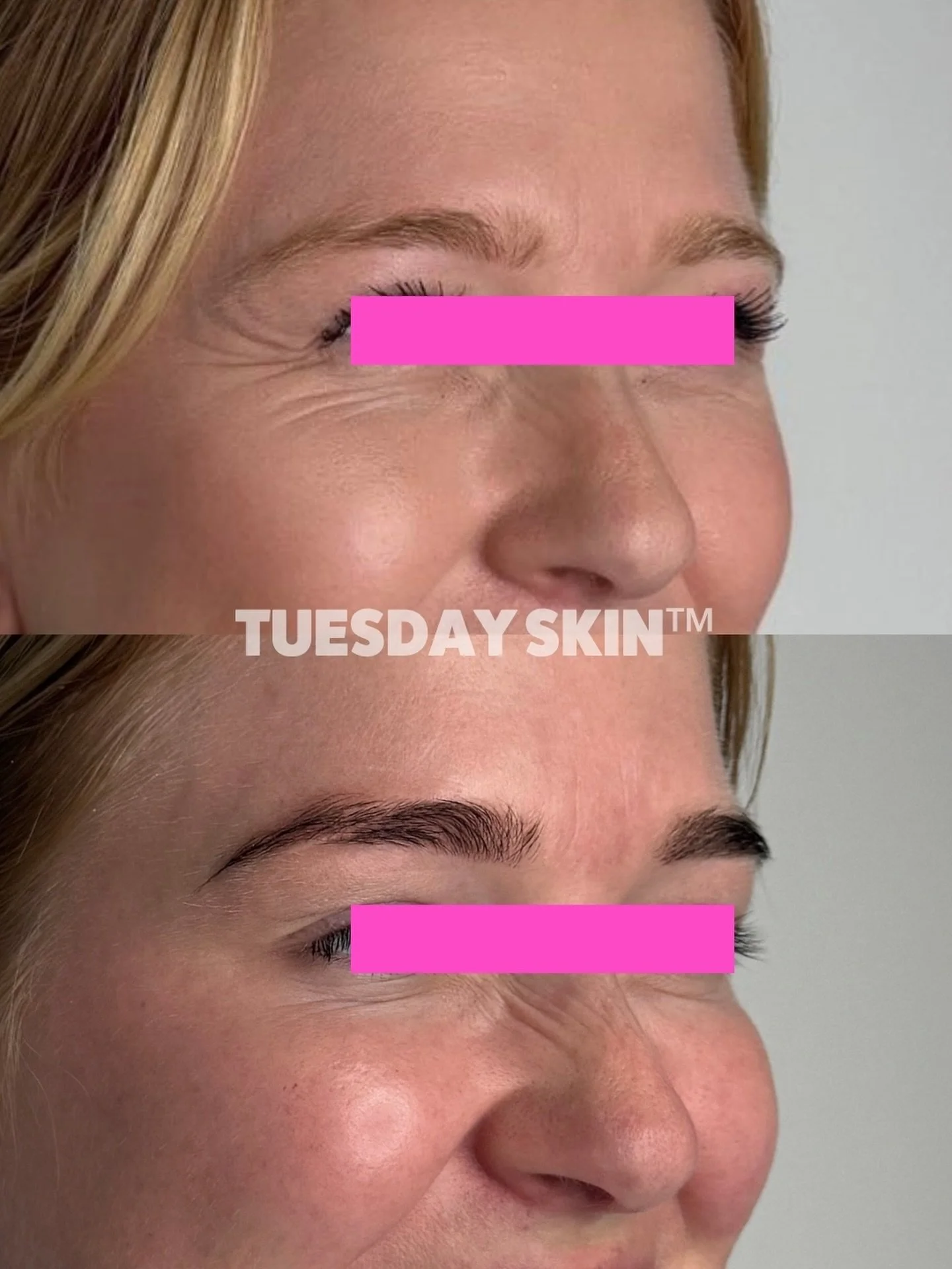 In case you forgot, I&rsquo;m still here 👀💉 a lil magic for your Sunday evening viewing pleasure - demonstrating just how good tox can be for the the lines around your eyes pre, vs 2 weeks post treatment. 

Preserving the integrity of your skin one